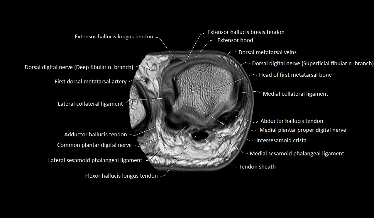 MRI Great Toe Anatomy – Labeled Axial, Coronal & Sagittal Cross-Sections