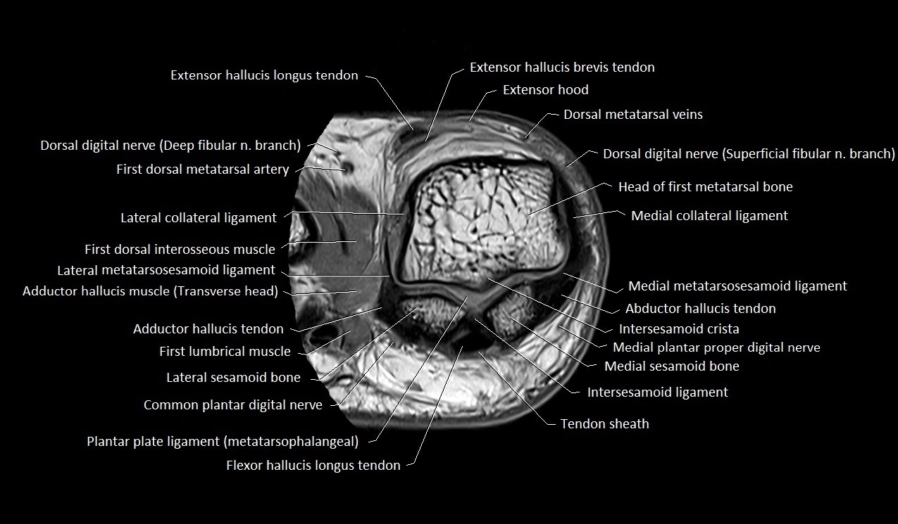 MRI Great Toe Anatomy – Labeled Axial, Coronal & Sagittal Cross-Sections