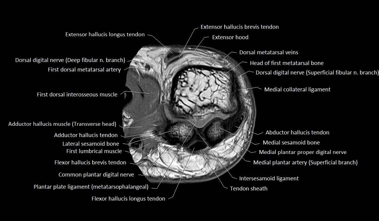 MRI Great Toe Anatomy – Labeled Axial, Coronal & Sagittal Cross-Sections