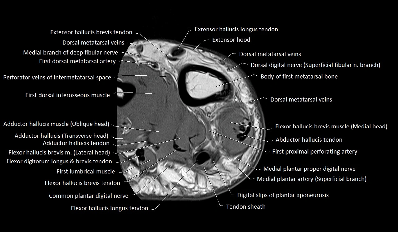MRI Great Toe Anatomy – Labeled Axial, Coronal & Sagittal Cross-Sections
