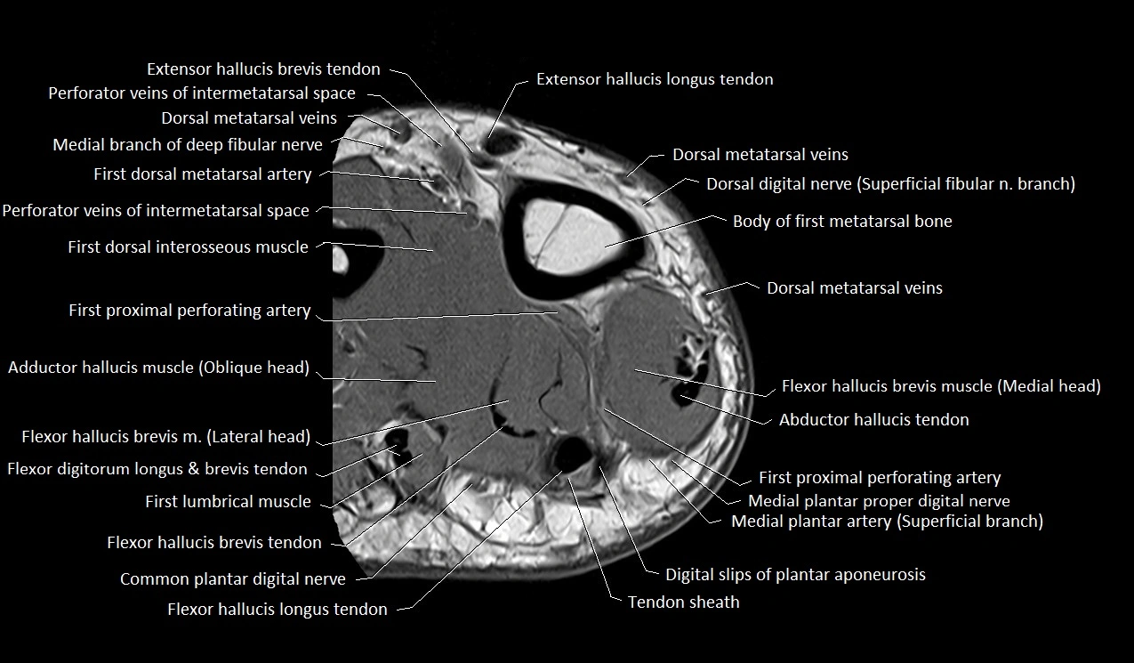 MRI Great Toe Anatomy – Labeled Axial, Coronal & Sagittal Cross-Sections