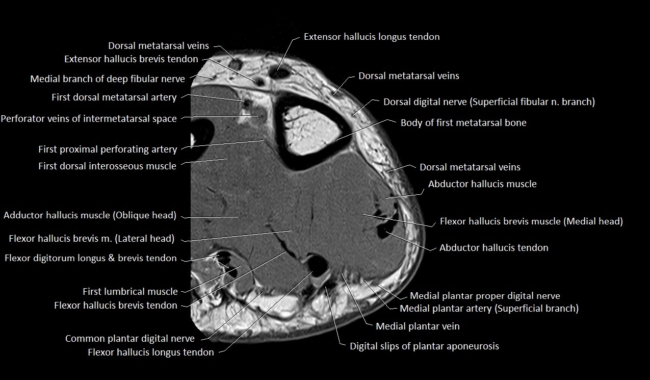 MRI Great Toe Anatomy – Labeled Axial, Coronal & Sagittal Cross-Sections