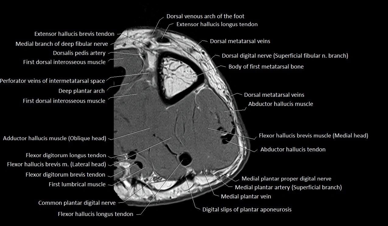 MRI Great Toe Anatomy – Labeled Axial, Coronal & Sagittal Cross-Sections