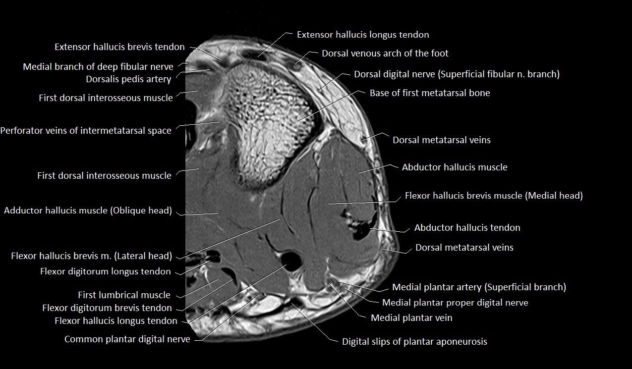 MRI Great Toe Anatomy – Labeled Axial, Coronal & Sagittal Cross-Sections