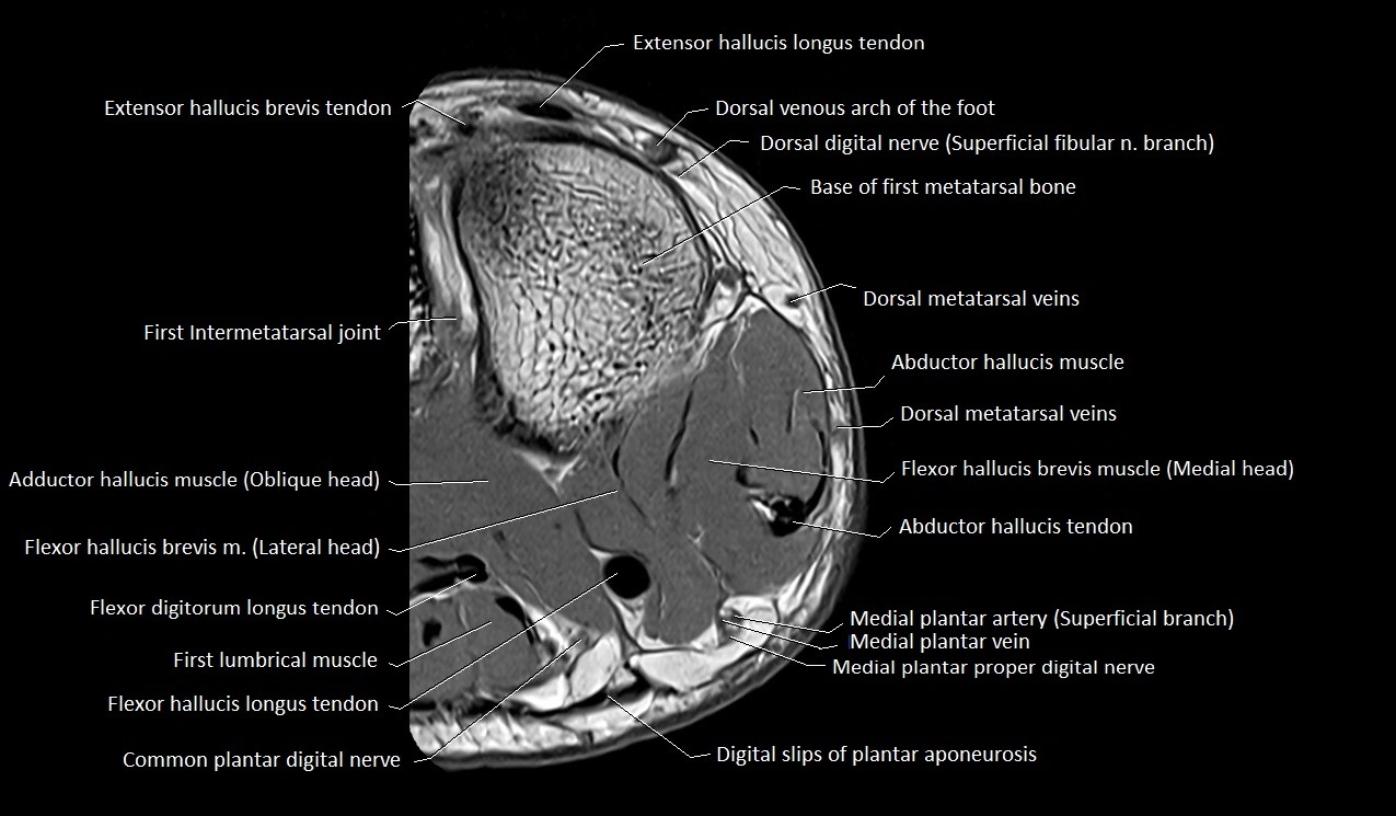 MRI Great Toe Anatomy – Labeled Axial, Coronal & Sagittal Cross-Sections