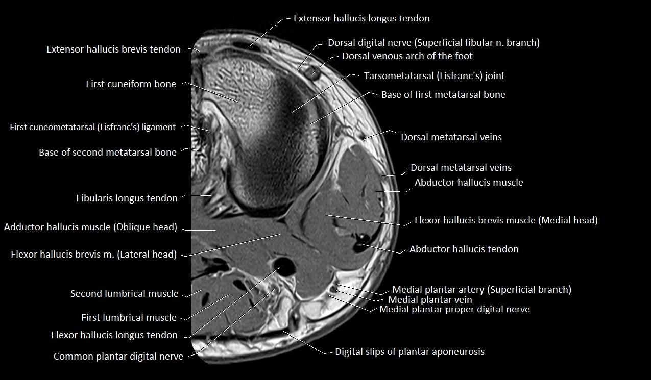 MRI Great Toe Anatomy – Labeled Axial, Coronal & Sagittal Cross-Sections