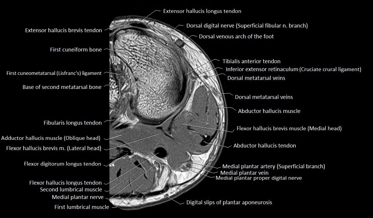 MRI Great Toe Anatomy – Labeled Axial, Coronal & Sagittal Cross-Sections
