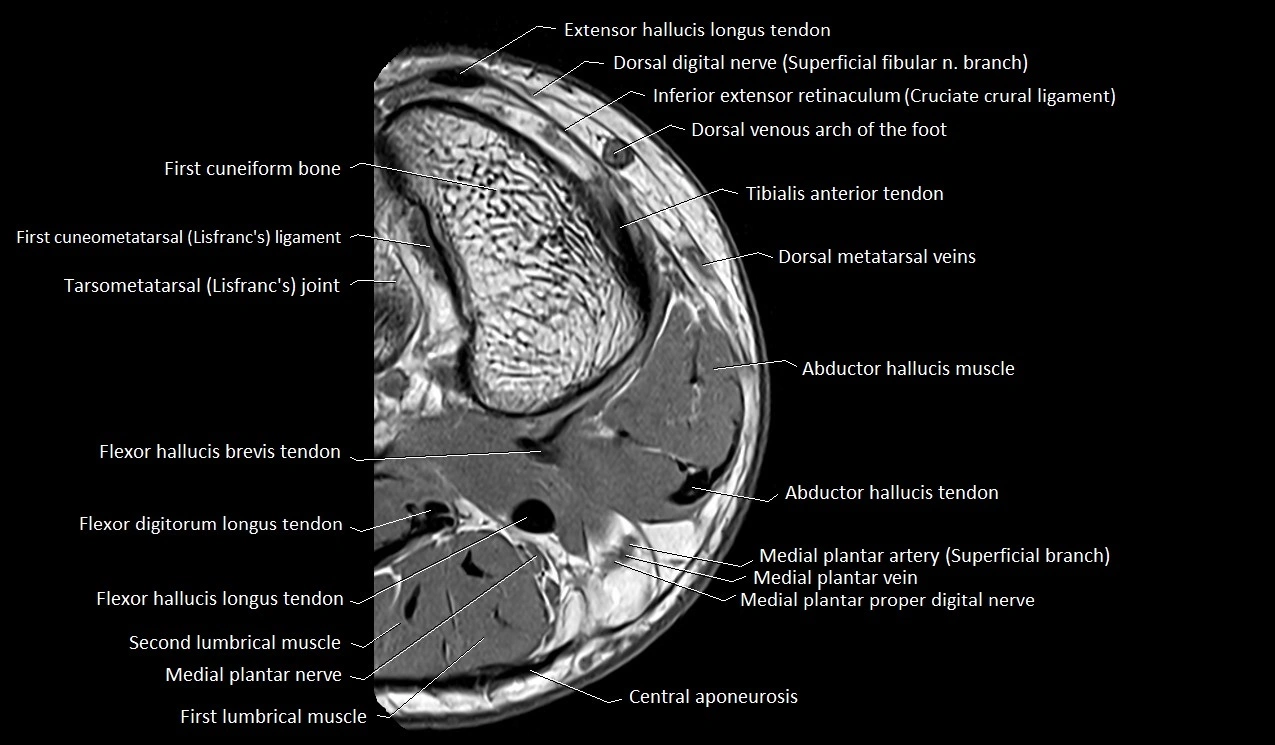 MRI Great Toe Anatomy – Labeled Axial, Coronal & Sagittal Cross-Sections