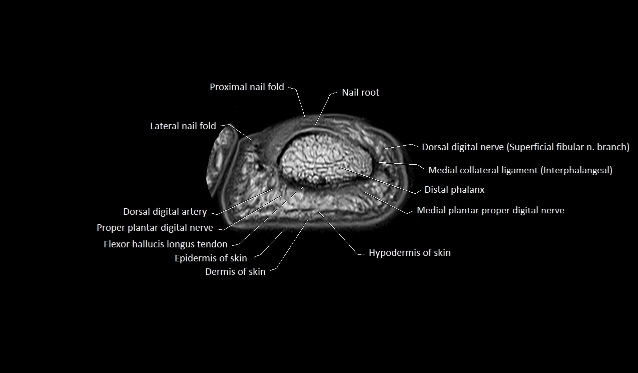 MRI Great Toe Anatomy – Labeled Axial, Coronal & Sagittal Cross-Sections