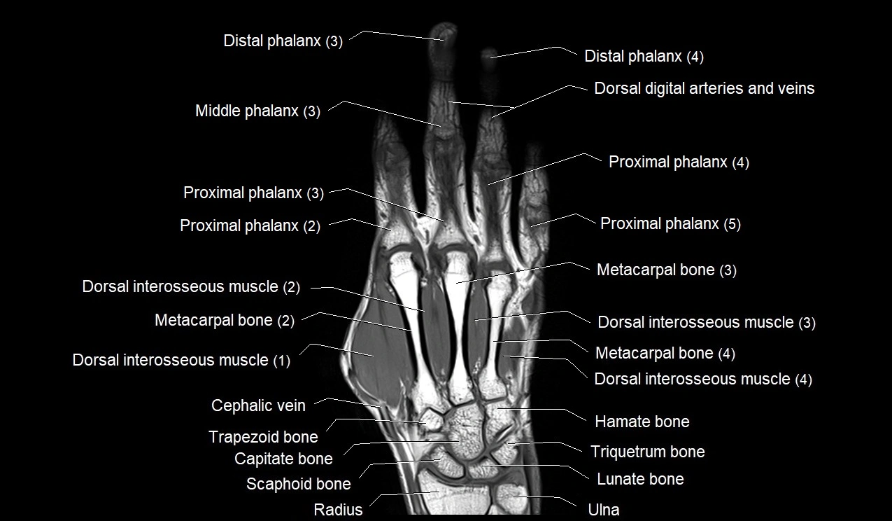 MRI Hand Anatomy – Labeled Axial, Coronal & Sagittal Images