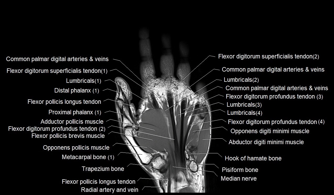 MRI Hand Anatomy – Labeled Axial, Coronal & Sagittal Images