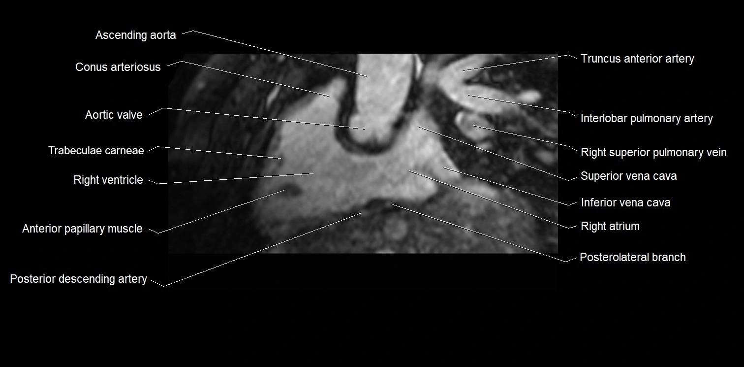 MRI Heart Anatomy – Coronary Arteries Labeled (Axial, Coronal, Sagittal)