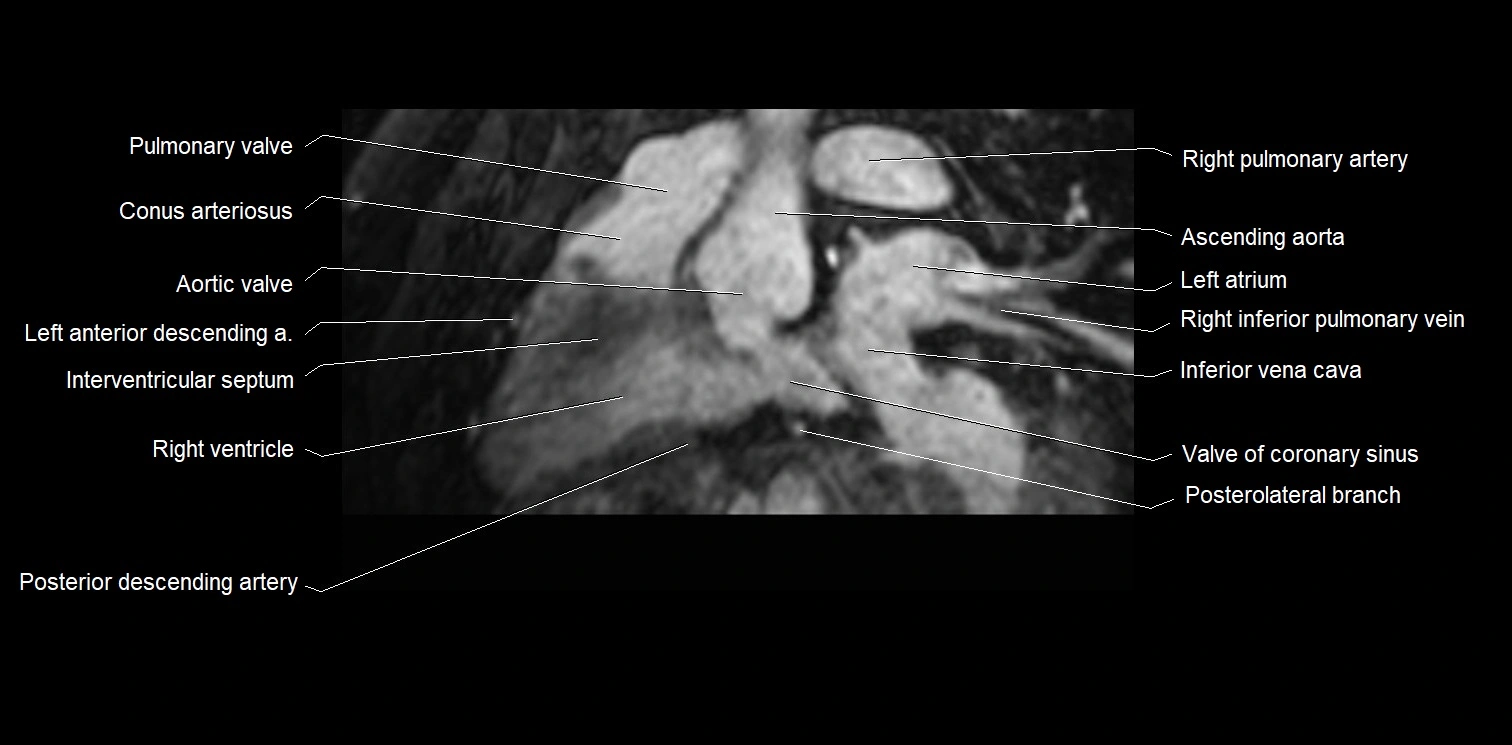 MRI Heart Anatomy – Coronary Arteries Labeled (Axial, Coronal, Sagittal)