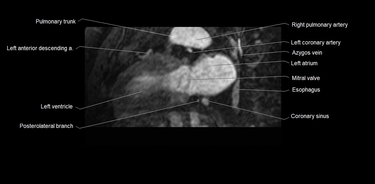 MRI Heart Anatomy – Coronary Arteries Labeled (Axial, Coronal, Sagittal)