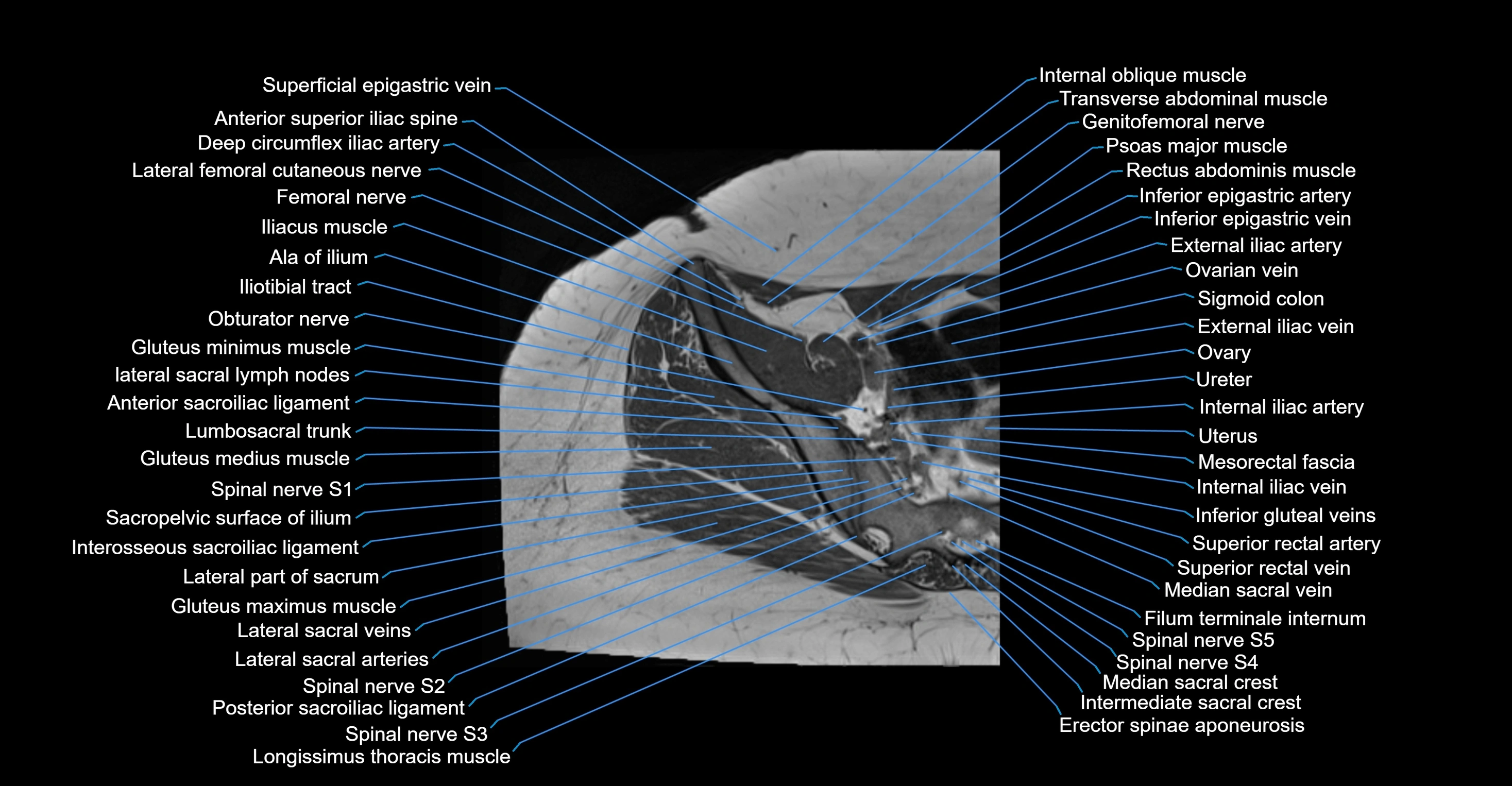 MRI Hip Anatomy – Axial, Coronal & Sagittal Cross-Sectional Labeled Images