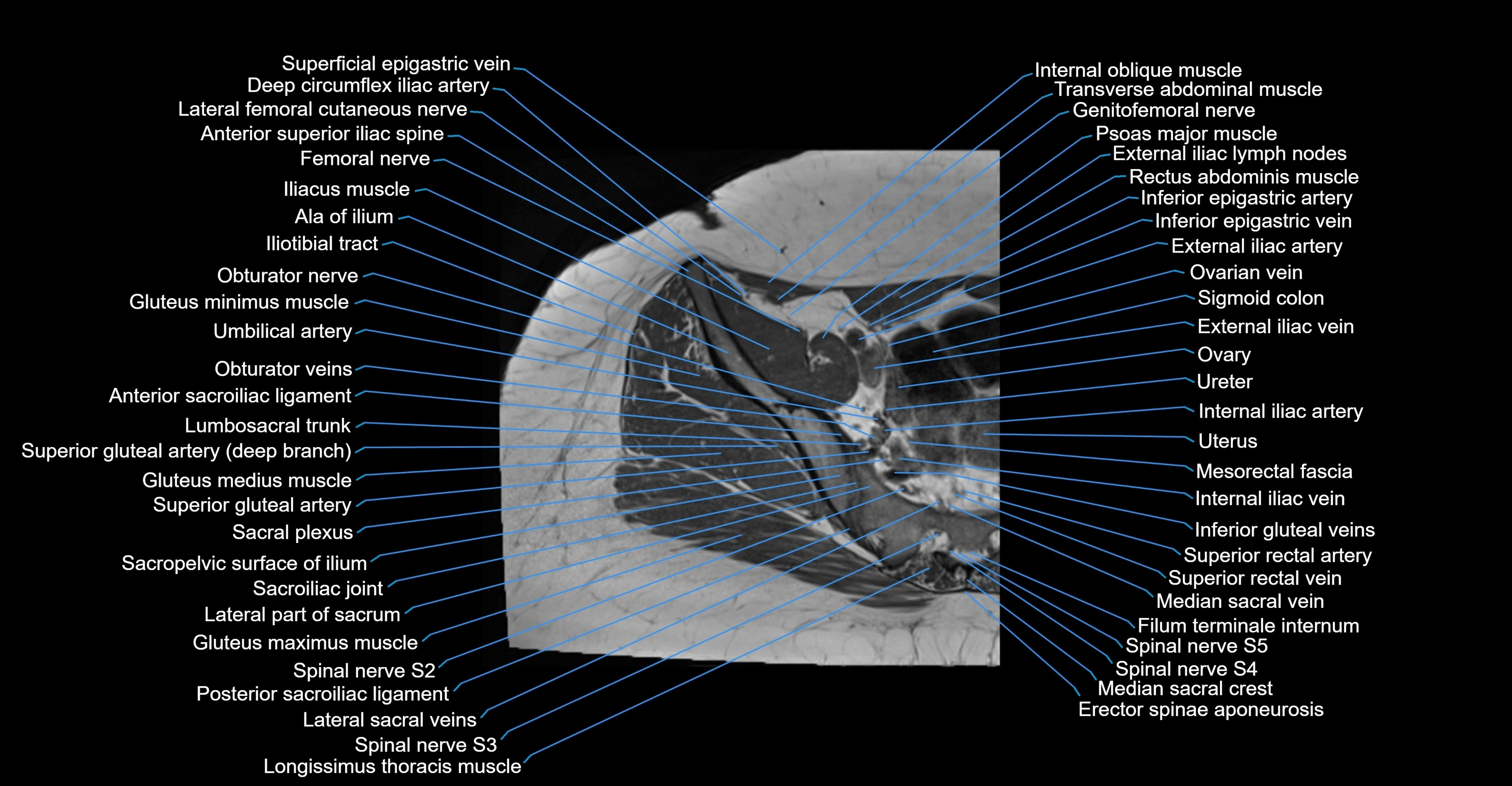 MRI Hip Anatomy – Axial, Coronal & Sagittal Cross-Sectional Labeled Images