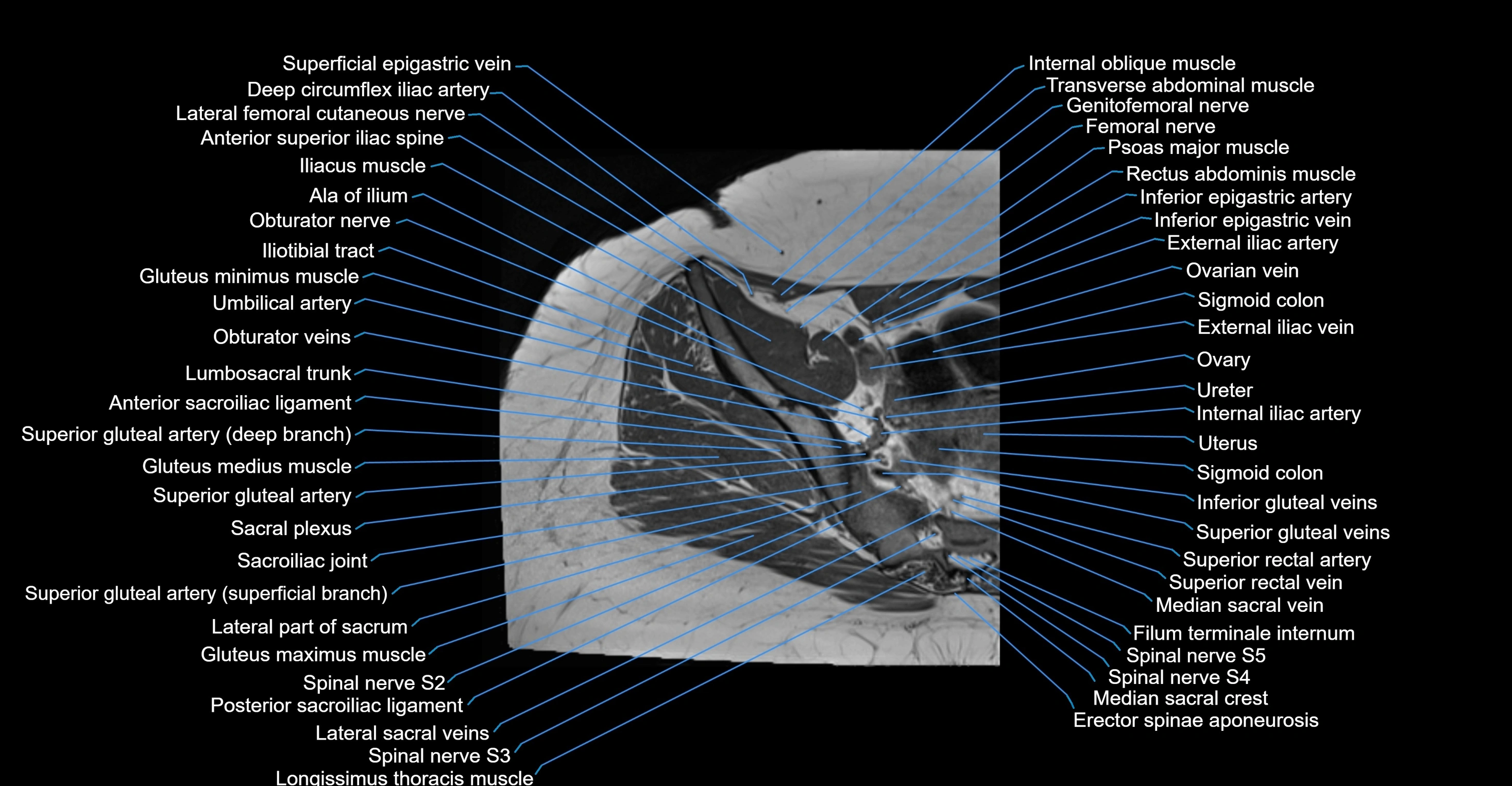MRI Hip Anatomy – Axial, Coronal & Sagittal Cross-Sectional Labeled Images