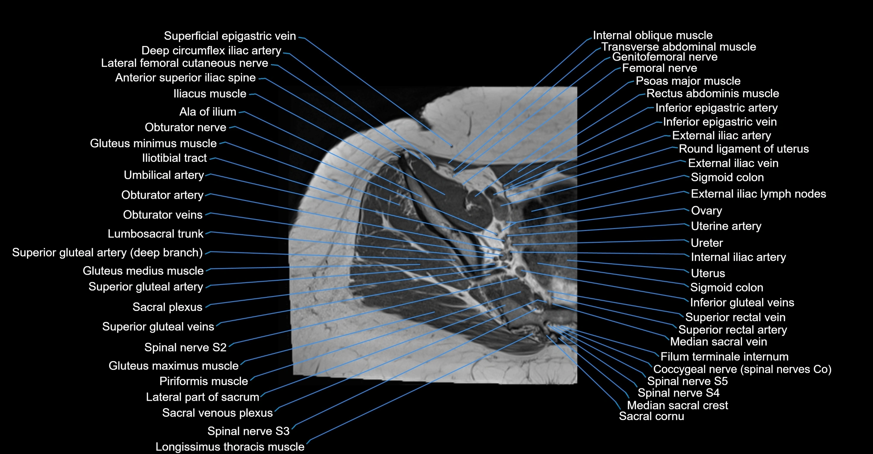 MRI Hip Anatomy – Axial, Coronal & Sagittal Cross-Sectional Labeled Images