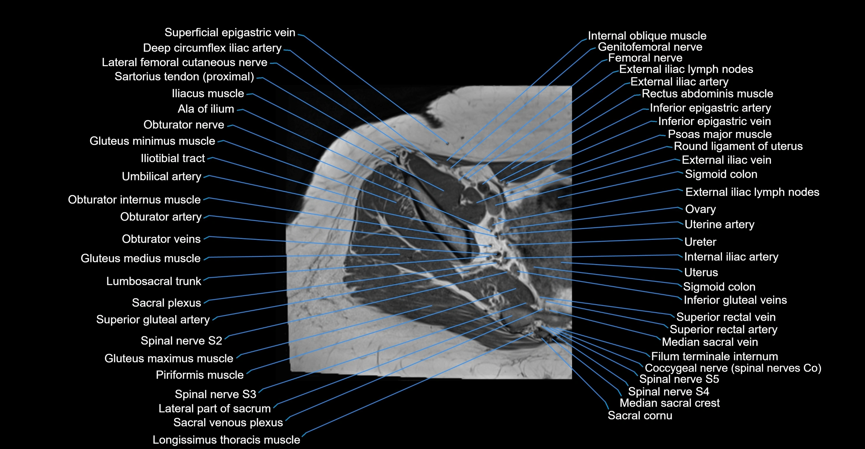 MRI Hip Anatomy – Axial, Coronal & Sagittal Cross-Sectional Labeled Images