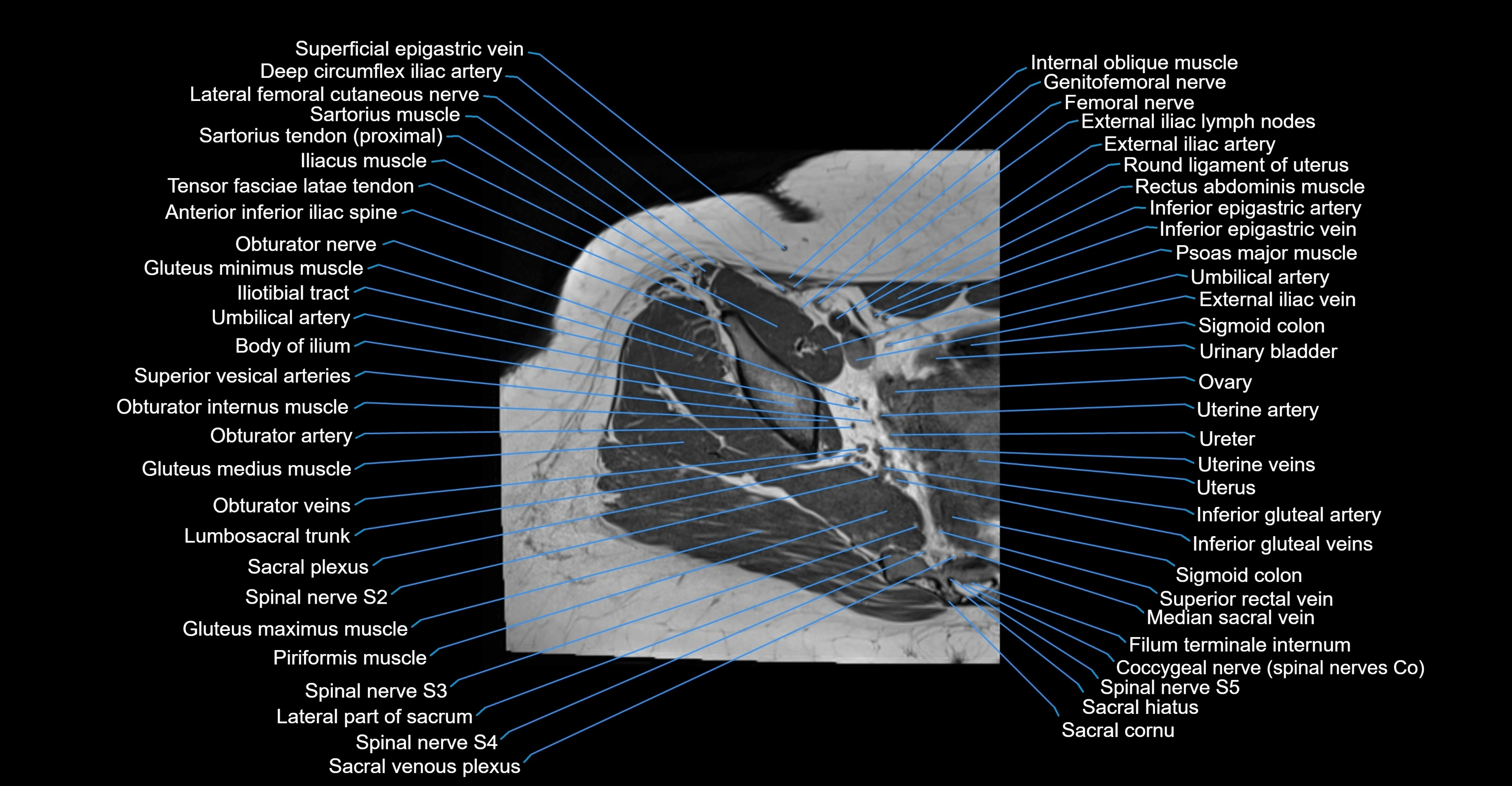 MRI Hip Anatomy – Axial, Coronal & Sagittal Cross-Sectional Labeled Images
