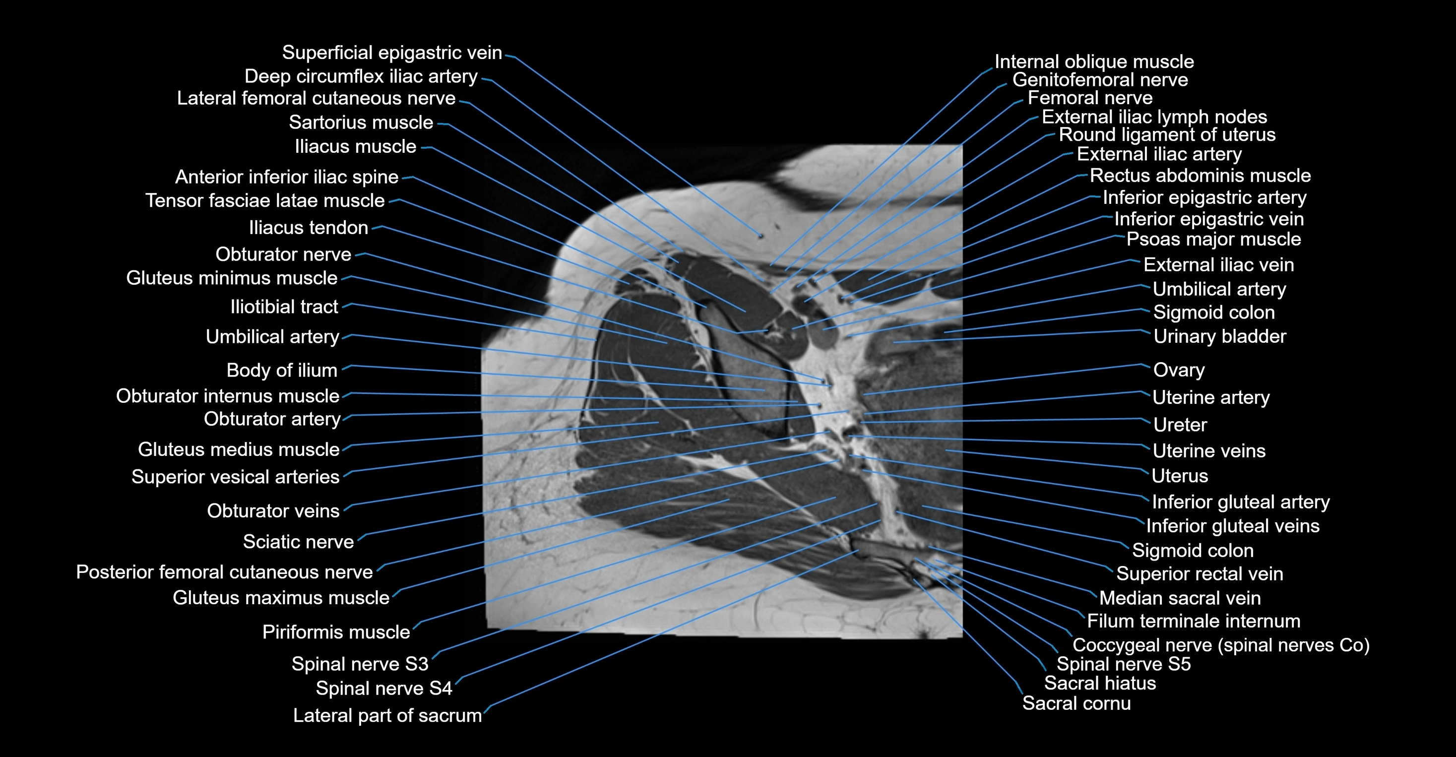 MRI Hip Anatomy – Axial, Coronal & Sagittal Cross-Sectional Labeled Images