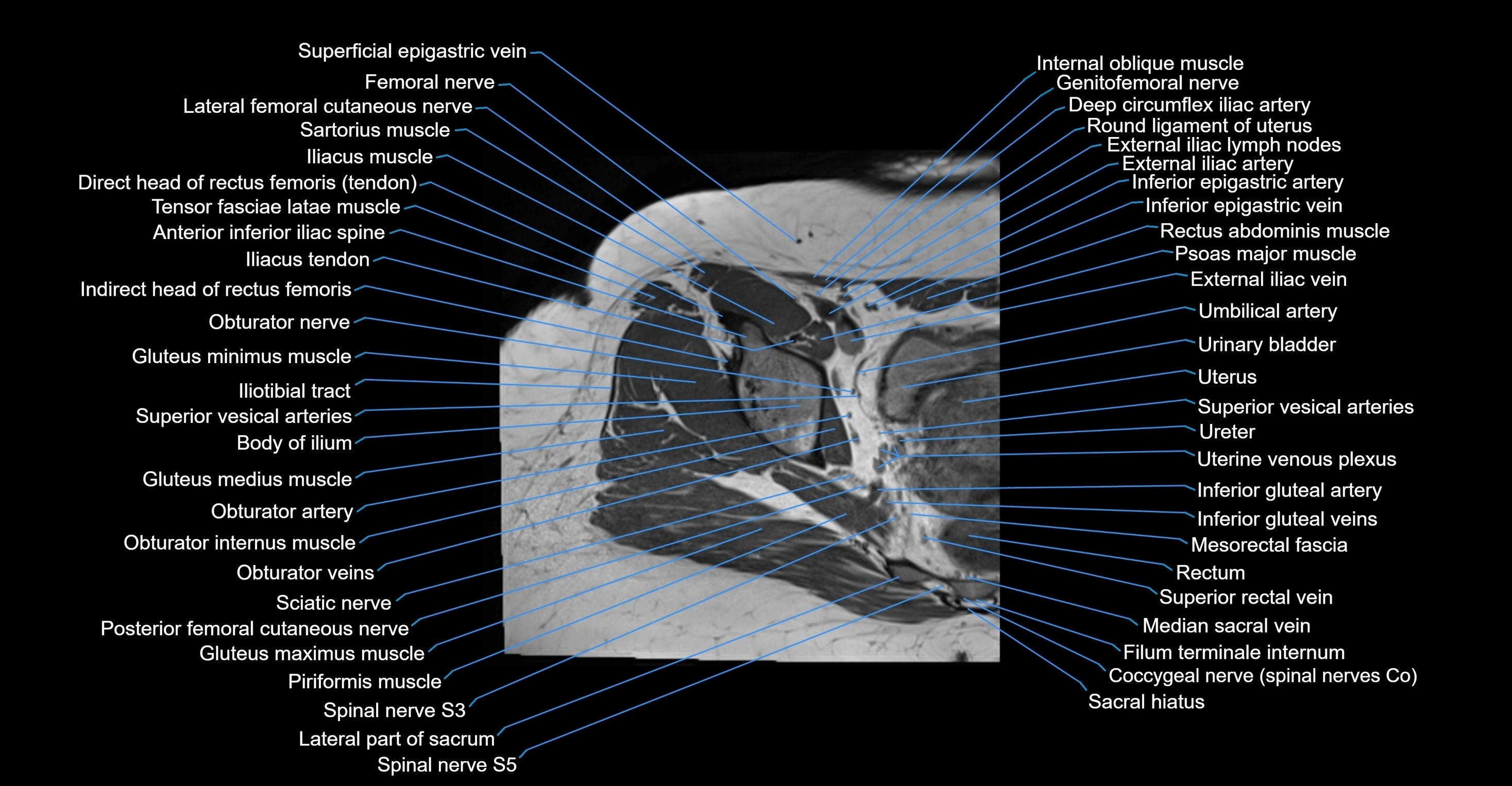MRI Hip Anatomy – Axial, Coronal & Sagittal Cross-Sectional Labeled Images
