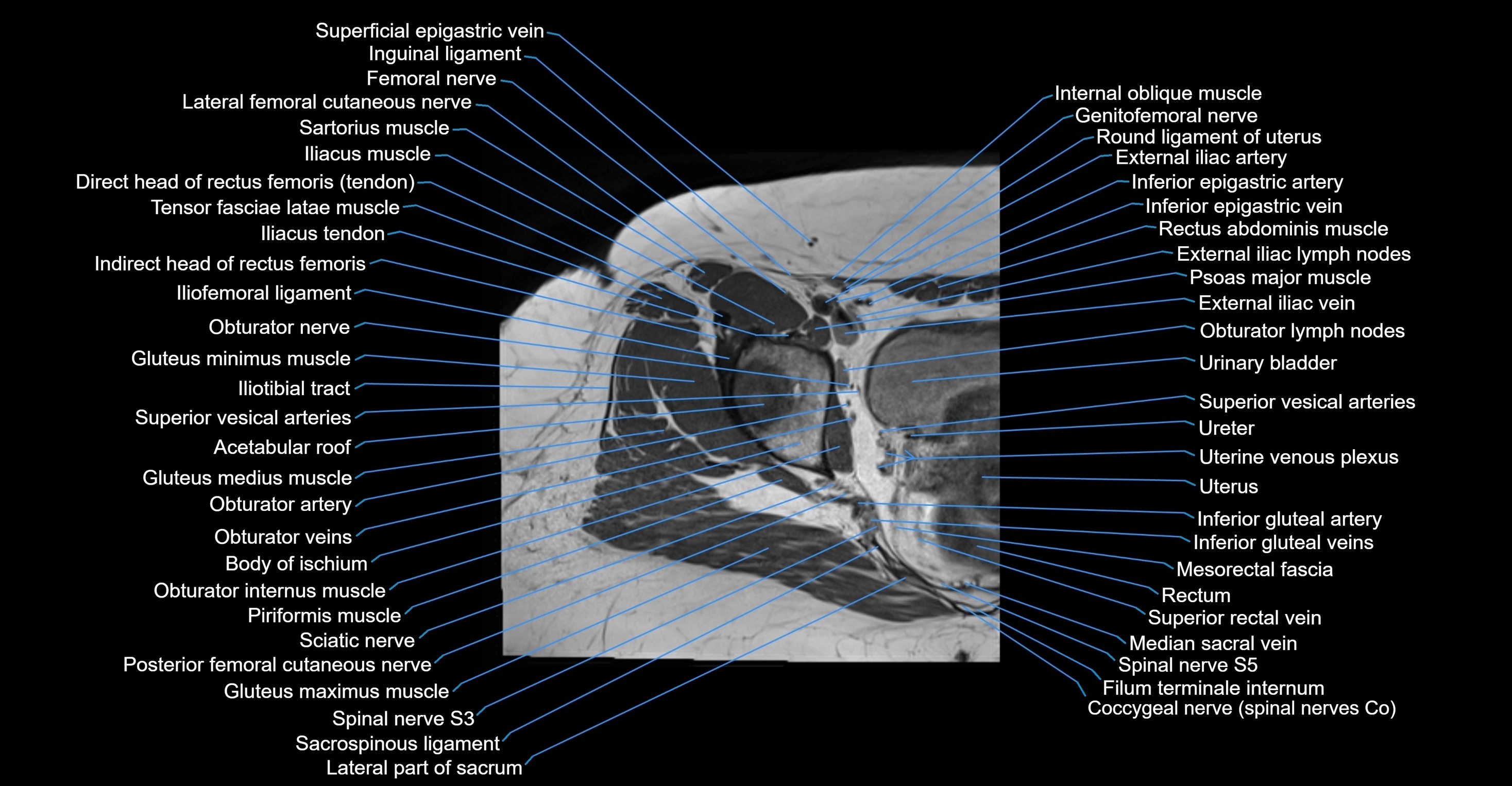 MRI Hip Anatomy – Axial, Coronal & Sagittal Cross-Sectional Labeled Images