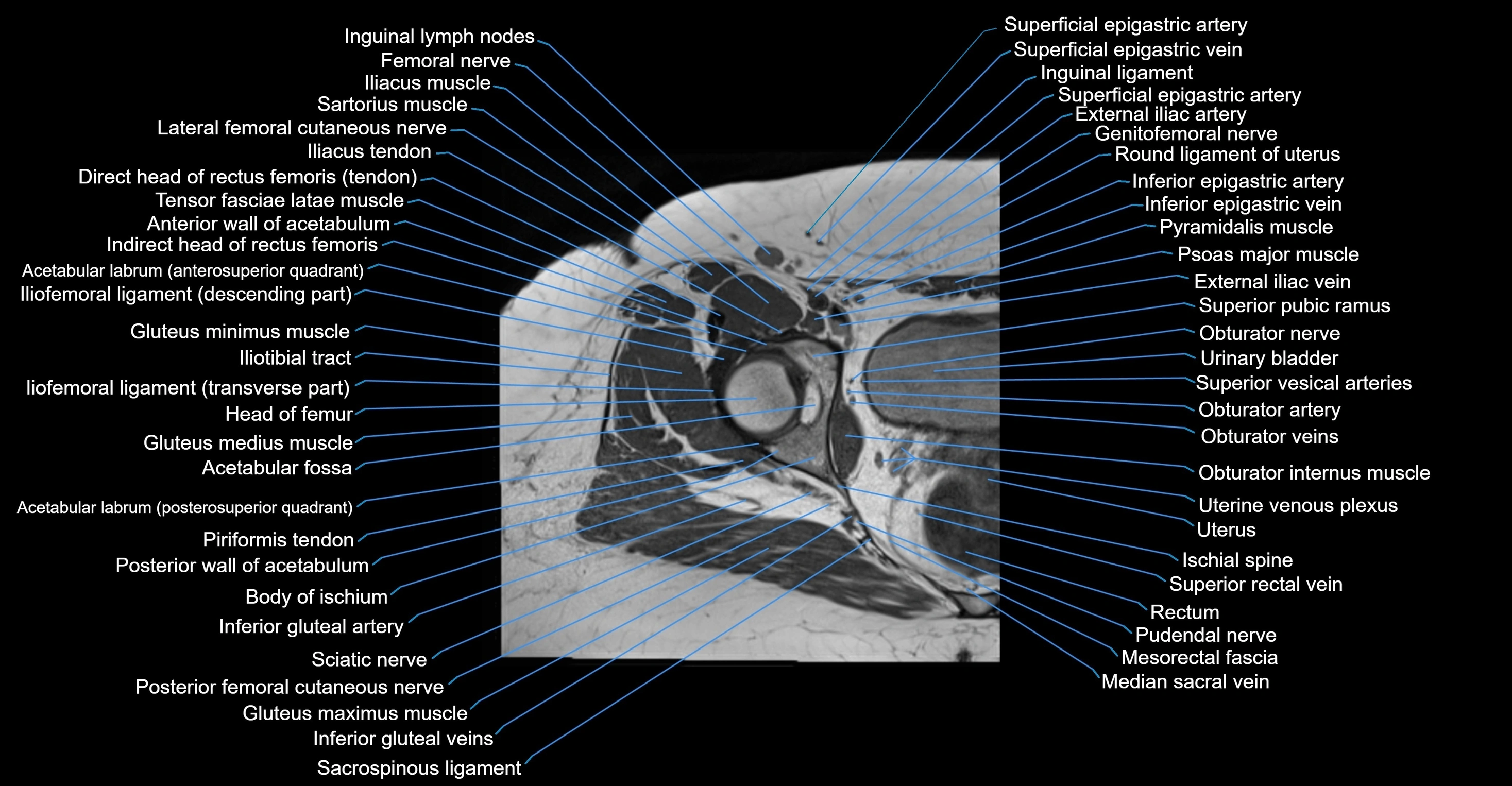 MRI Hip Anatomy – Axial, Coronal & Sagittal Cross-Sectional Labeled Images
