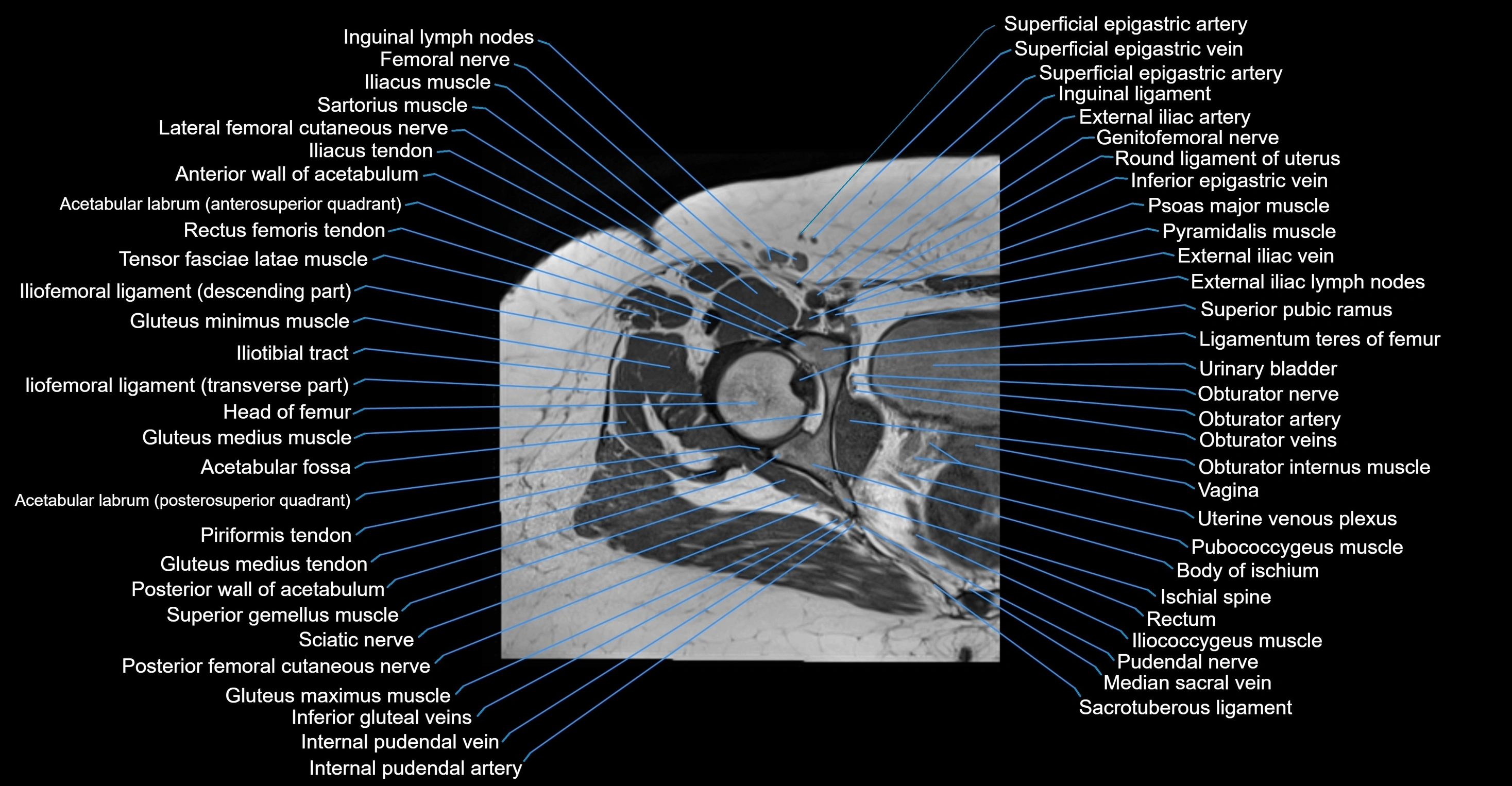 MRI Hip Anatomy – Axial, Coronal & Sagittal Cross-Sectional Labeled Images