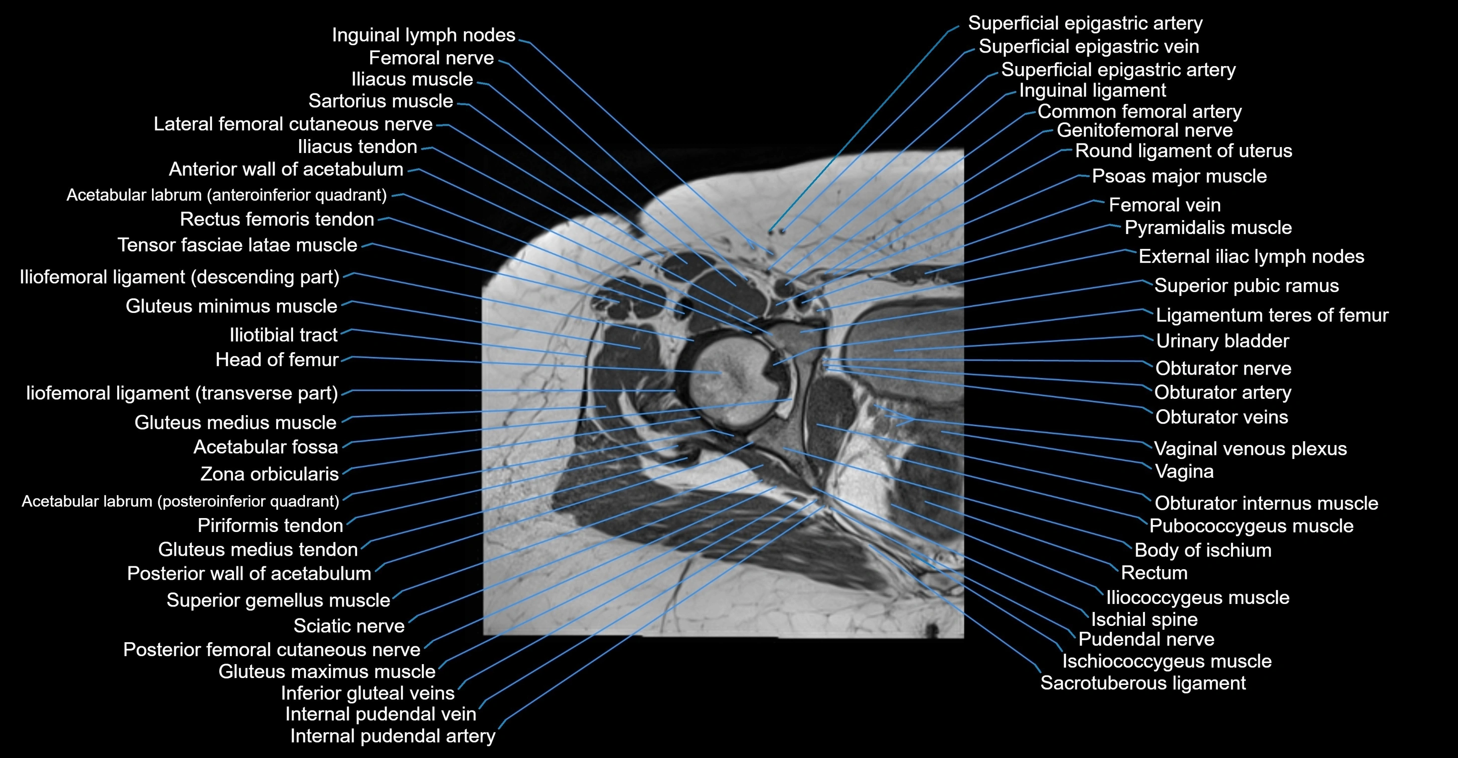 MRI Hip Anatomy – Axial, Coronal & Sagittal Cross-Sectional Labeled Images