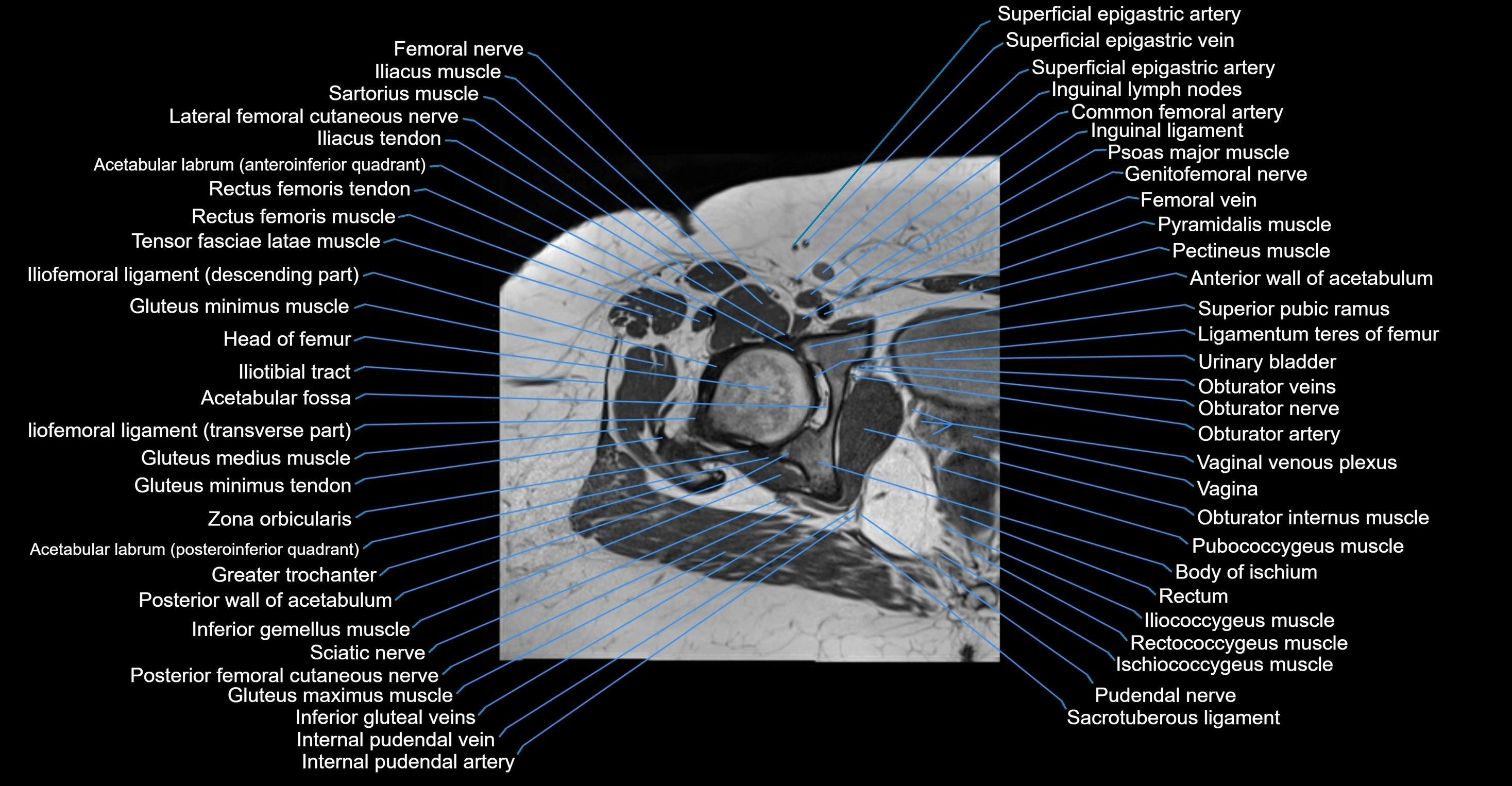 MRI Hip Anatomy – Axial, Coronal & Sagittal Cross-Sectional Labeled Images