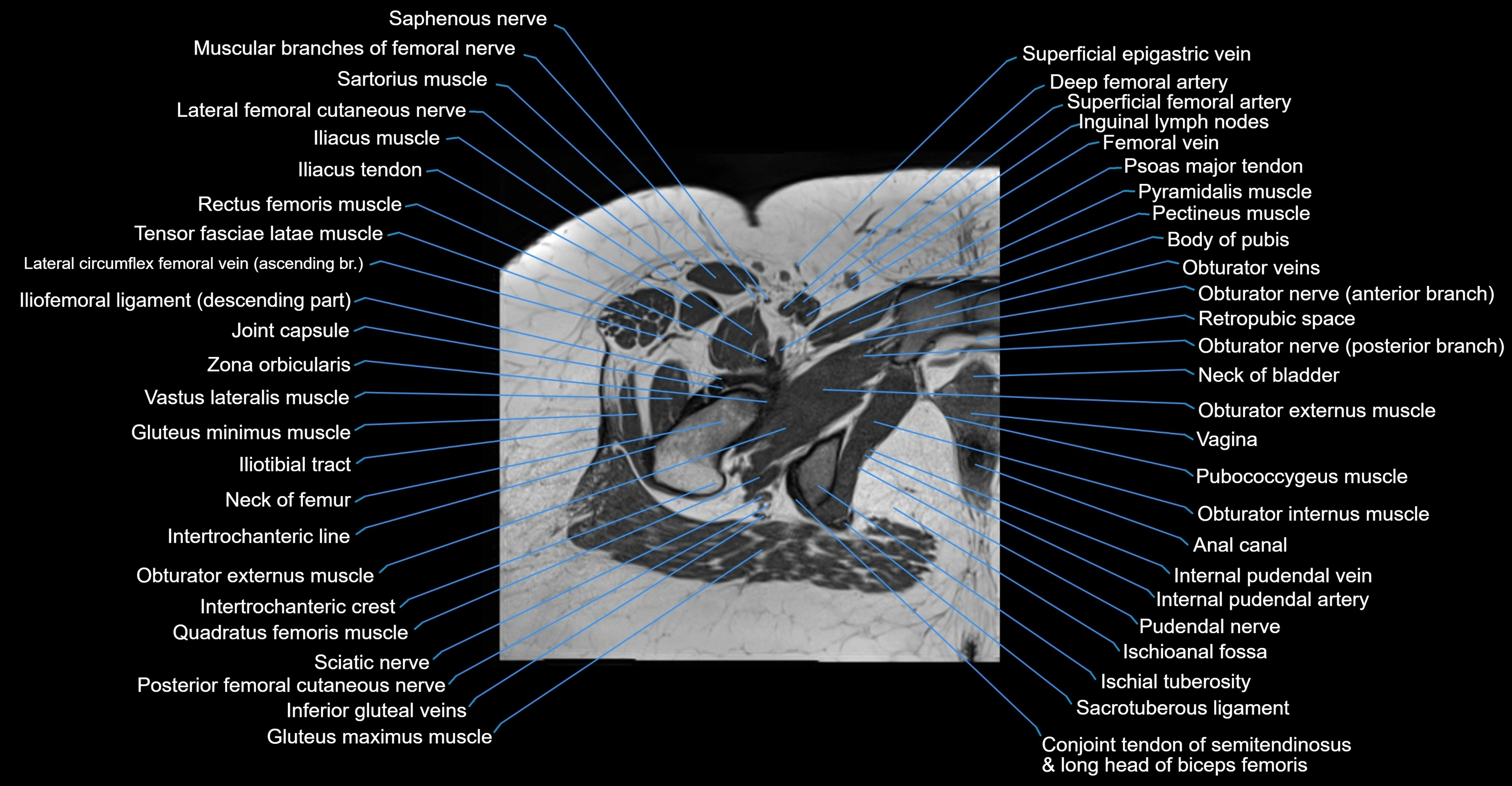 MRI Hip Anatomy – Axial, Coronal & Sagittal Cross-Sectional Labeled Images