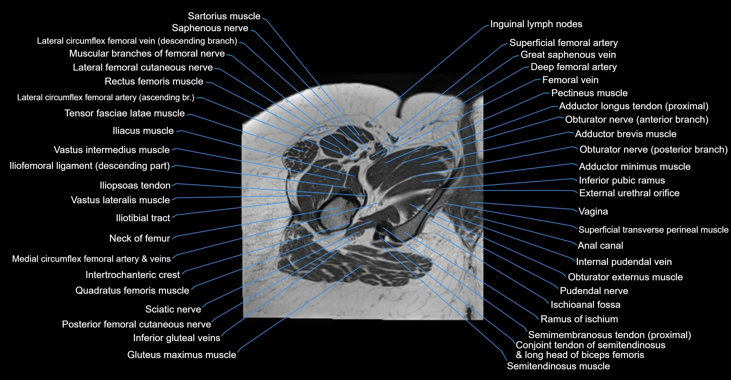 MRI Hip Anatomy – Axial, Coronal & Sagittal Cross-Sectional Labeled Images