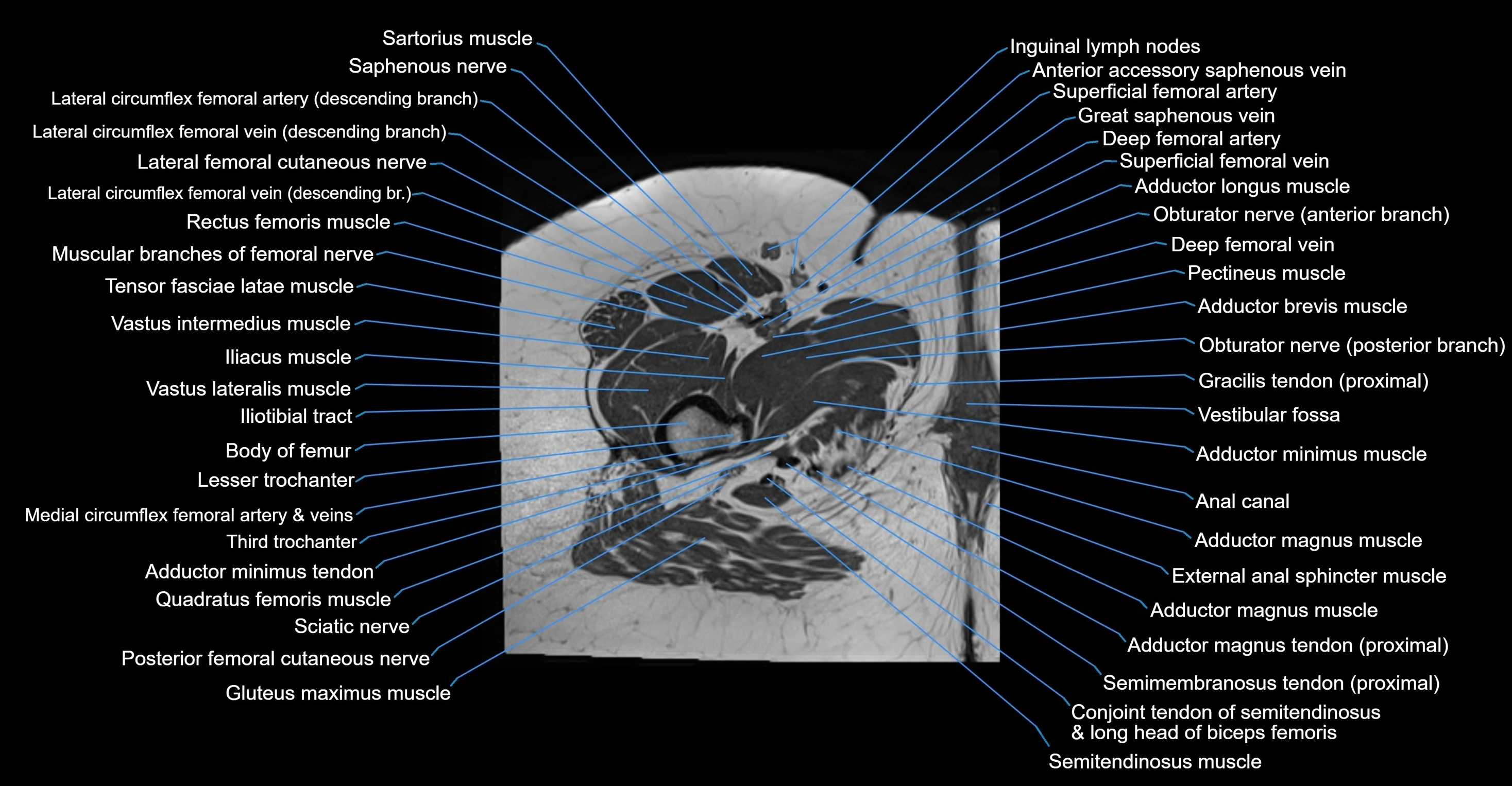 MRI Hip Anatomy – Axial, Coronal & Sagittal Cross-Sectional Labeled Images