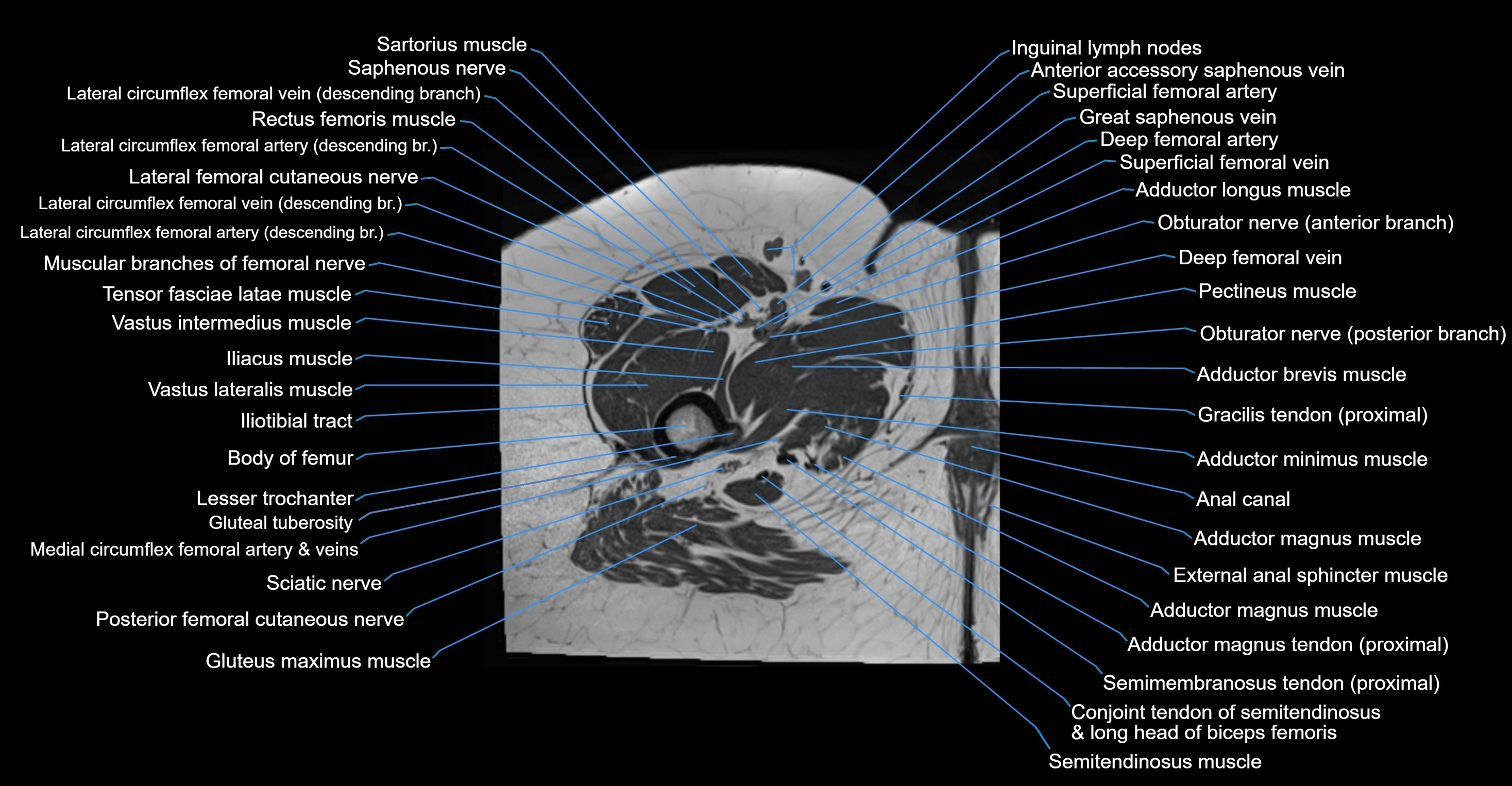MRI Hip Anatomy – Axial, Coronal & Sagittal Cross-Sectional Labeled Images