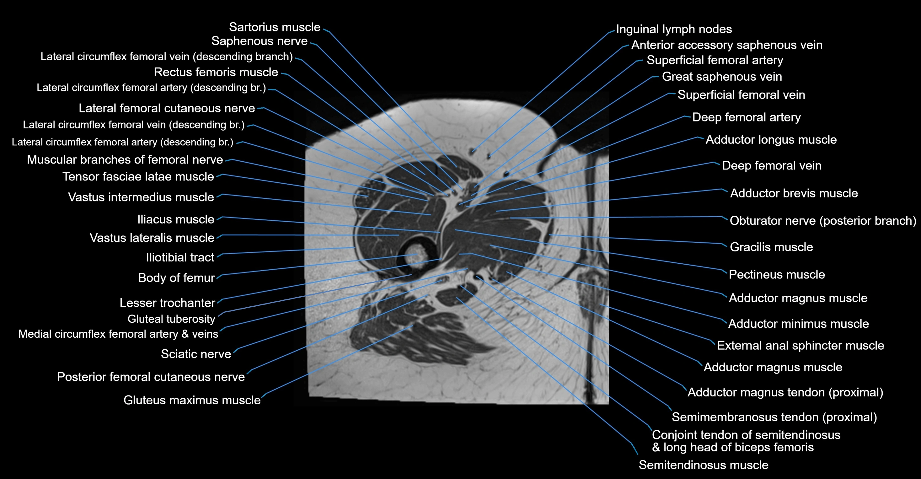MRI Hip Anatomy – Axial, Coronal & Sagittal Cross-Sectional Labeled Images