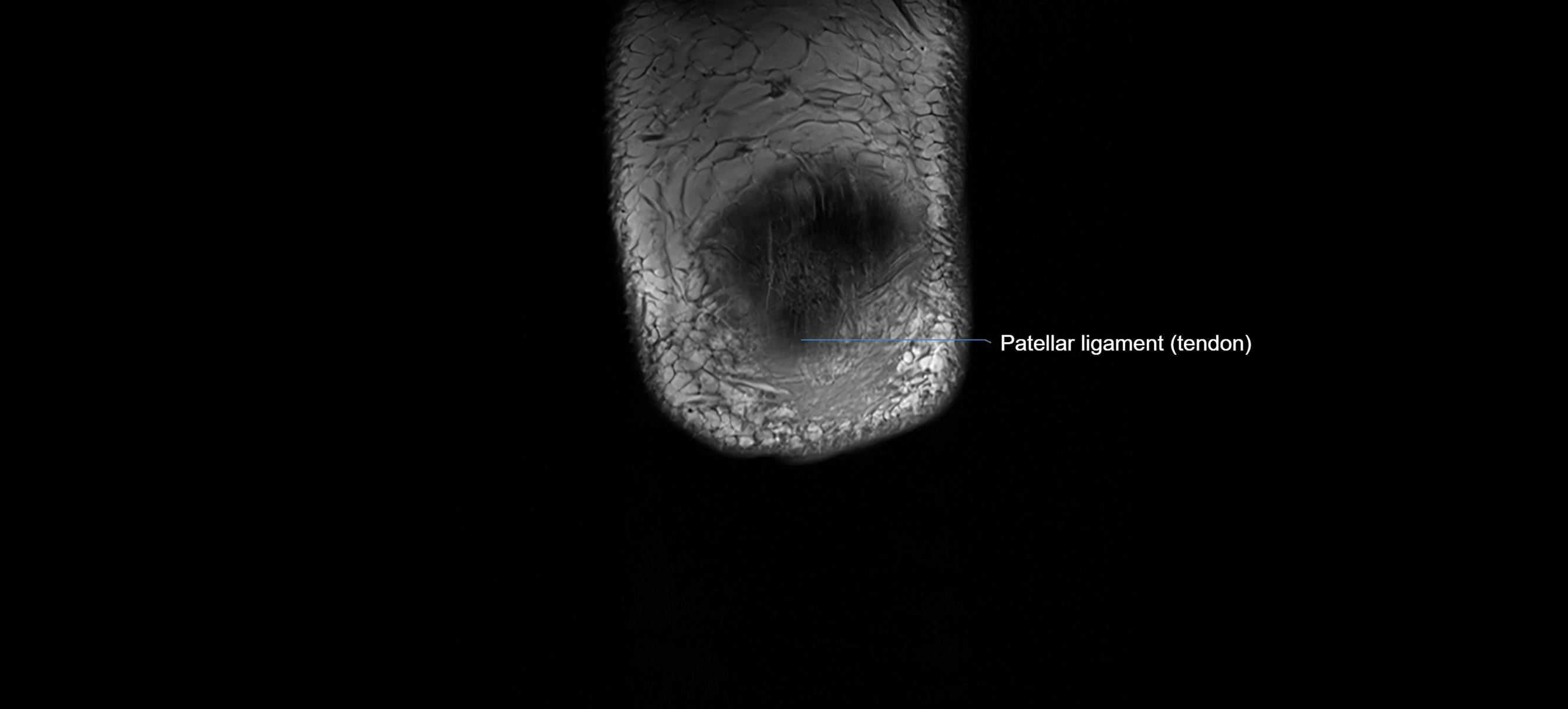 MRI Knee Ligaments – Labeled ACL, PCL, MCL & LCL Anatomy in All Planes