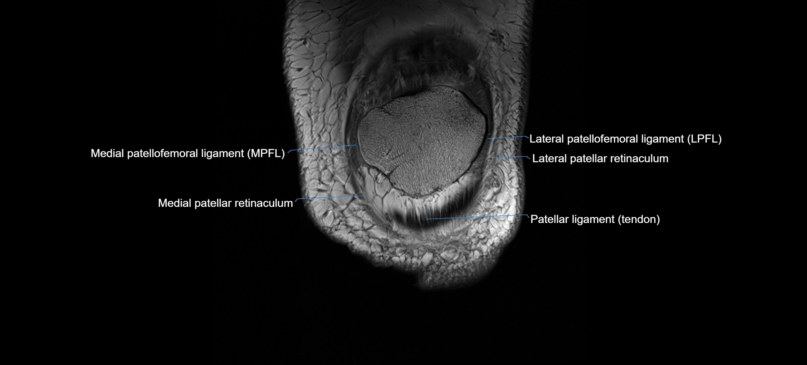 MRI Knee Ligaments – Labeled ACL, PCL, MCL & LCL Anatomy in All Planes