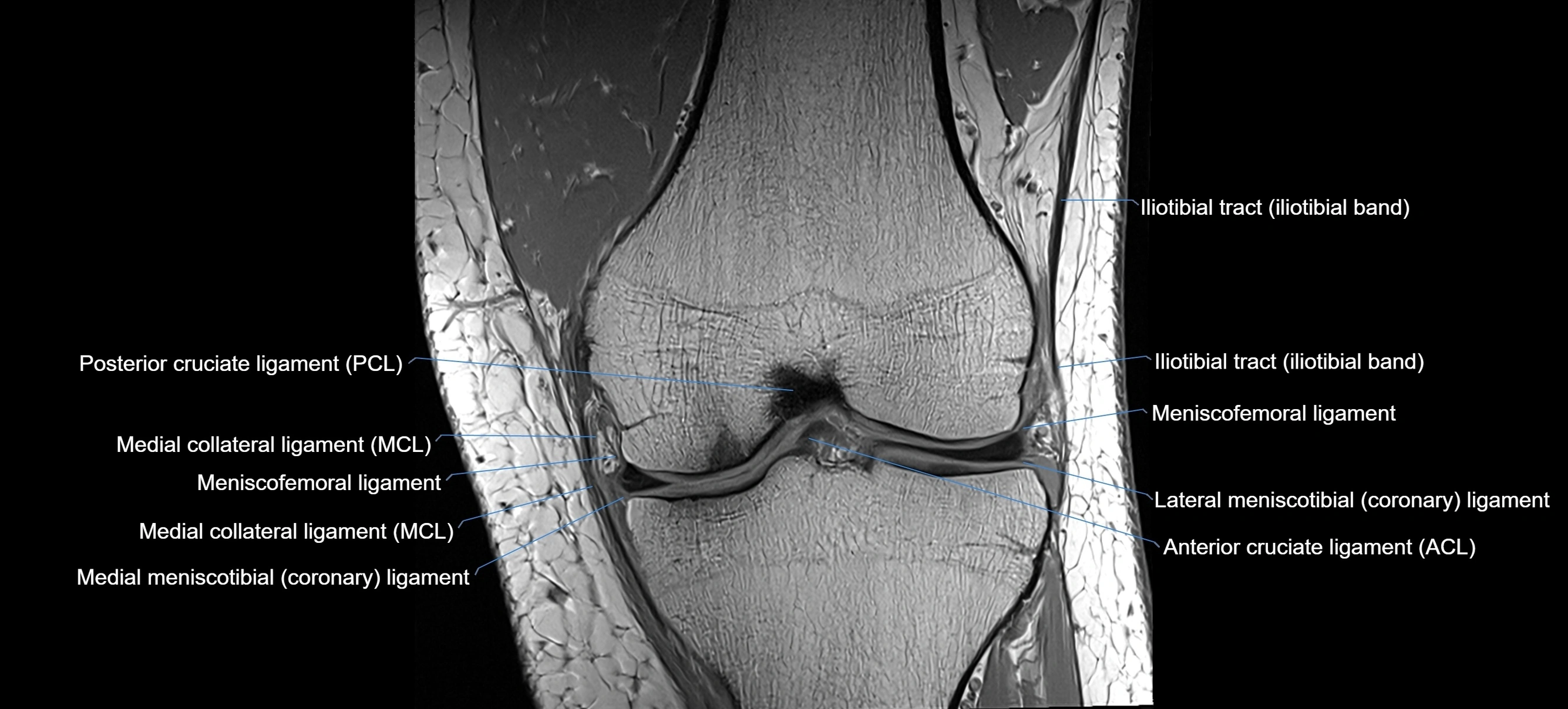 MRI Knee Ligaments – Labeled ACL, PCL, MCL & LCL Anatomy in All Planes