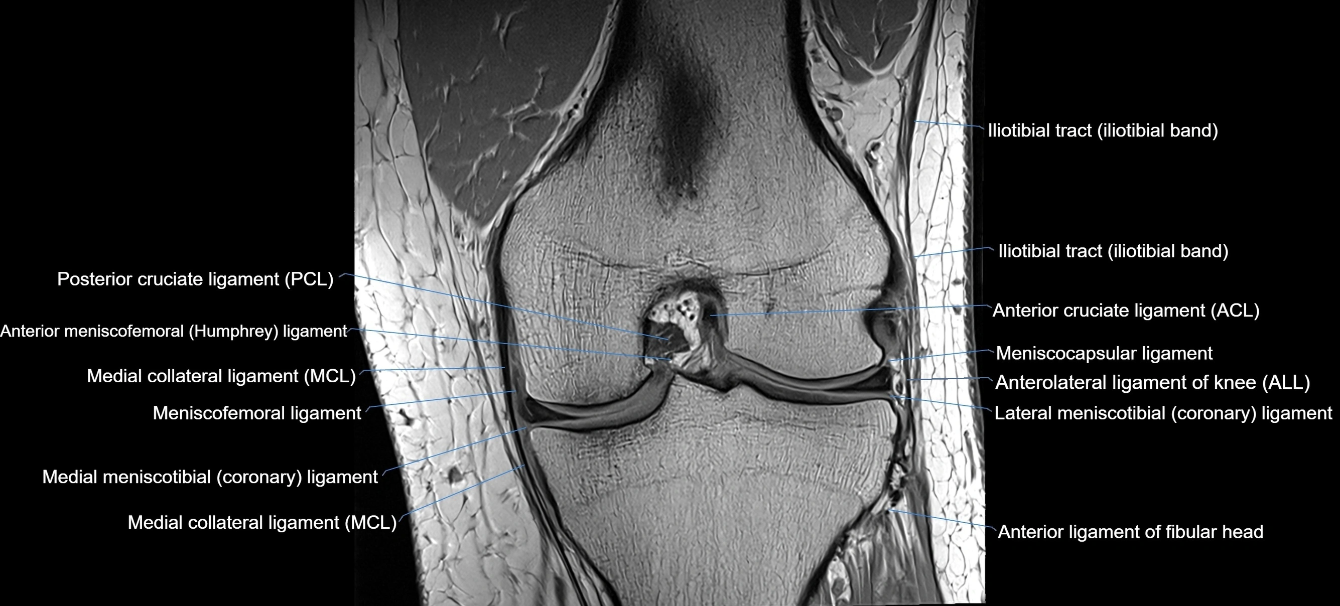 MRI Knee Ligaments – Labeled ACL, PCL, MCL & LCL Anatomy in All Planes