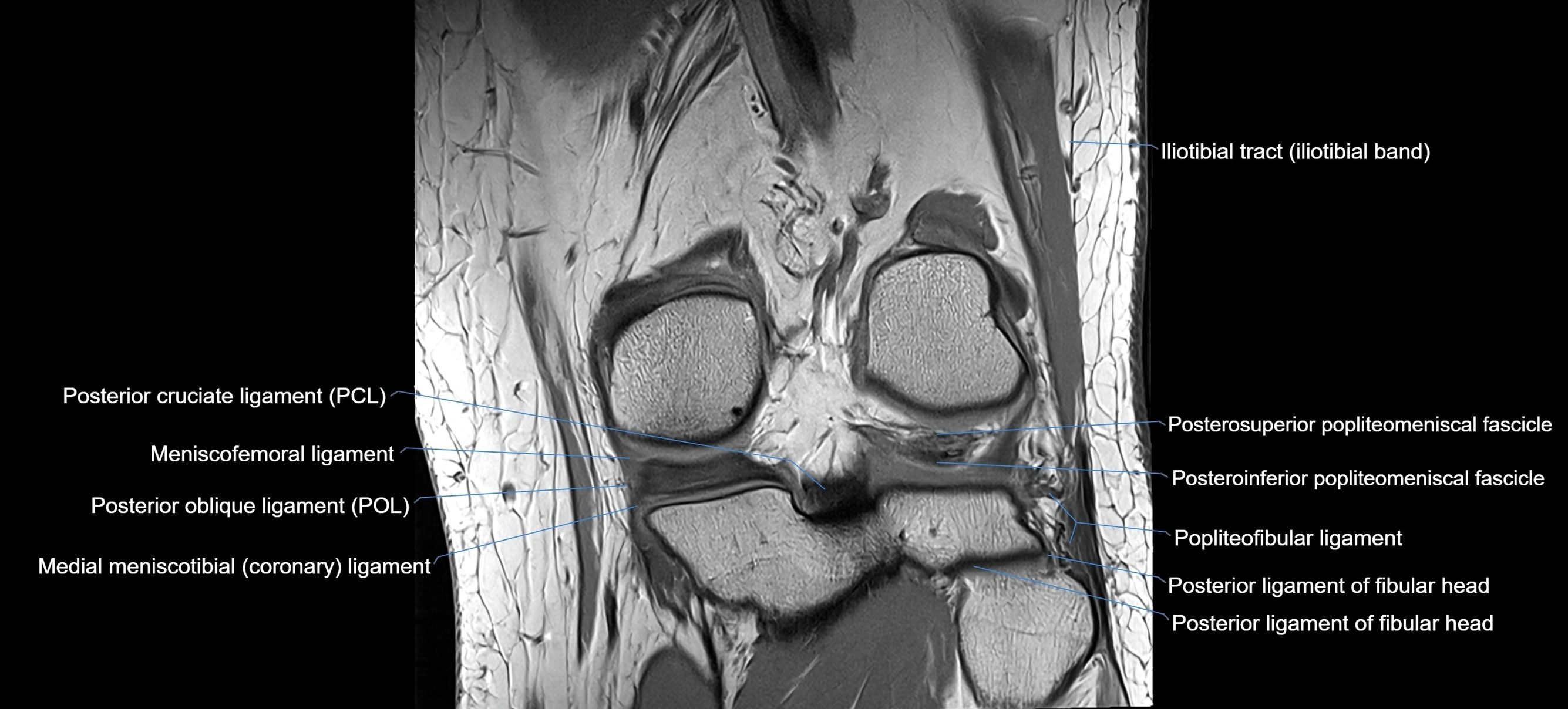 MRI Knee Ligaments – Labeled ACL, PCL, MCL & LCL Anatomy in All Planes