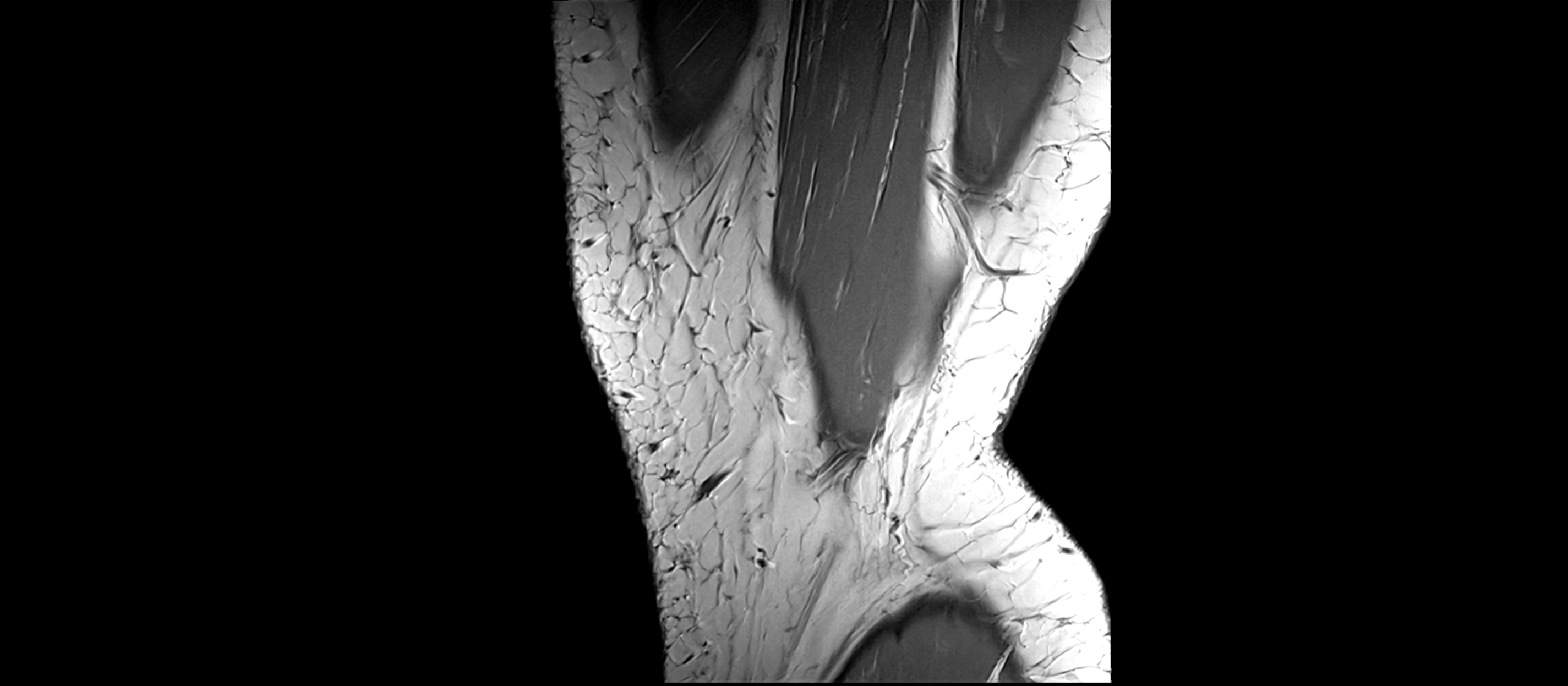 MRI Knee Ligaments – Labeled ACL, PCL, MCL & LCL Anatomy in All Planes