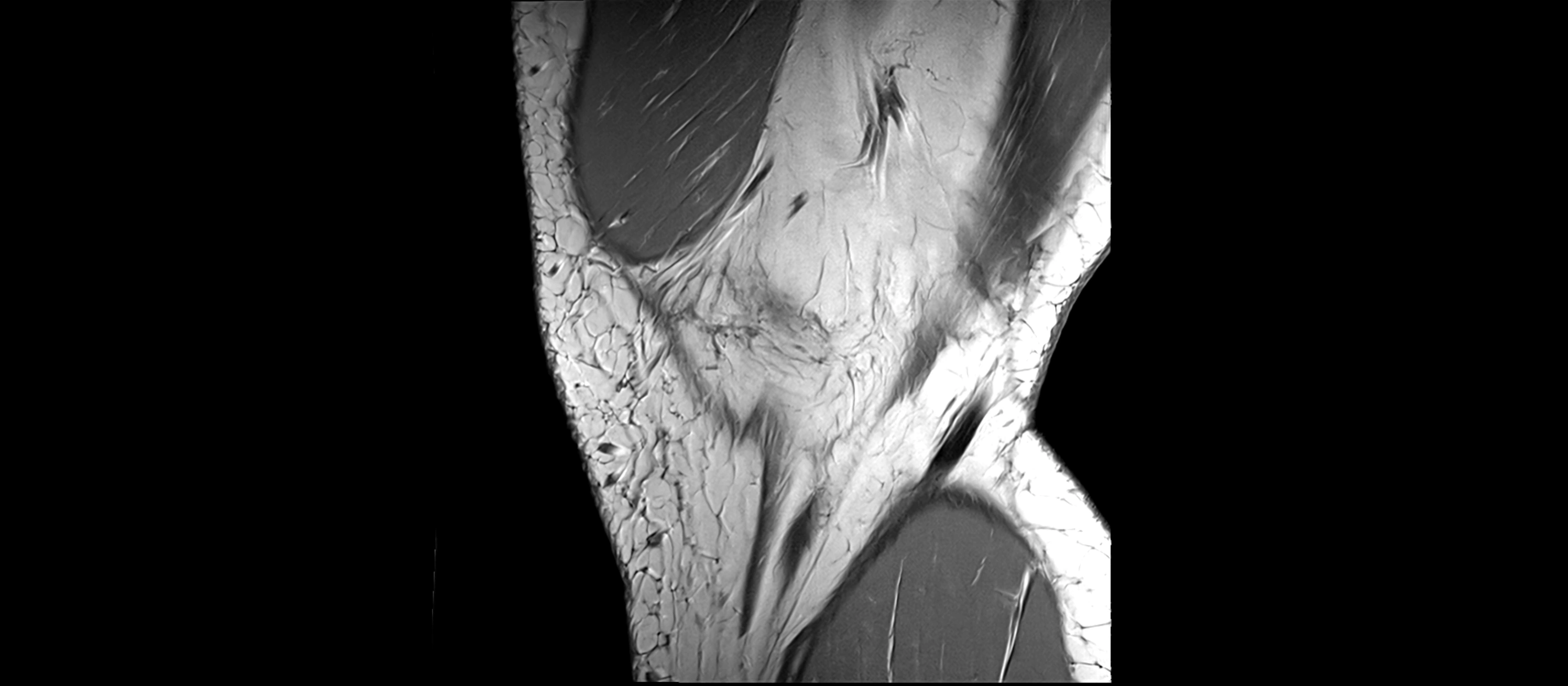 MRI Knee Ligaments – Labeled ACL, PCL, MCL & LCL Anatomy in All Planes