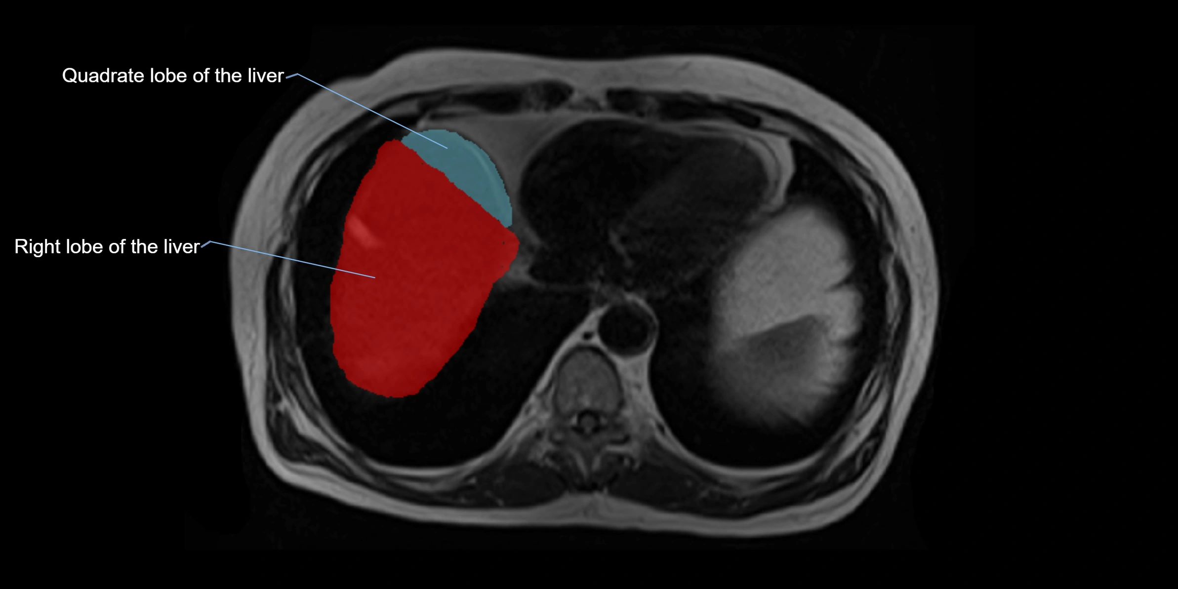 MRI Liver Anatomy – Axial Segments & Lobes (Labeled)