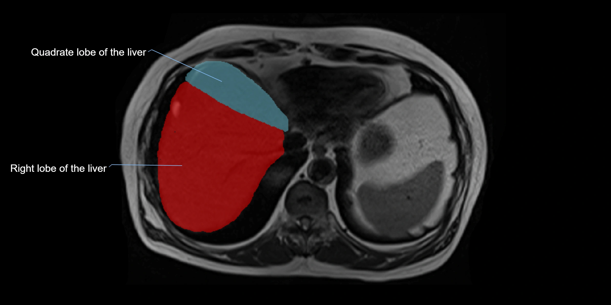 MRI Liver Anatomy – Axial Segments & Lobes (Labeled)