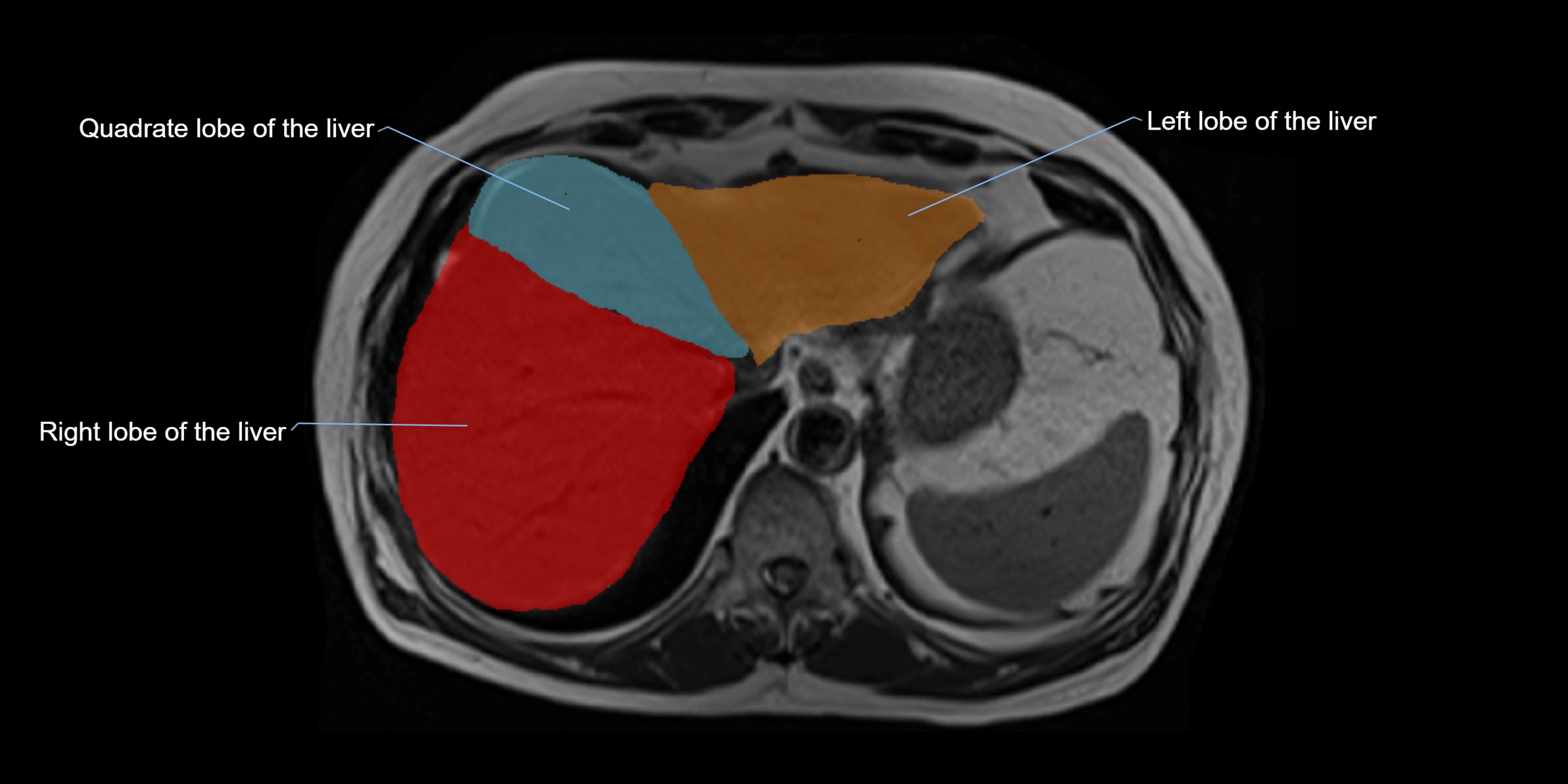 MRI Liver Anatomy – Axial Segments & Lobes (Labeled)