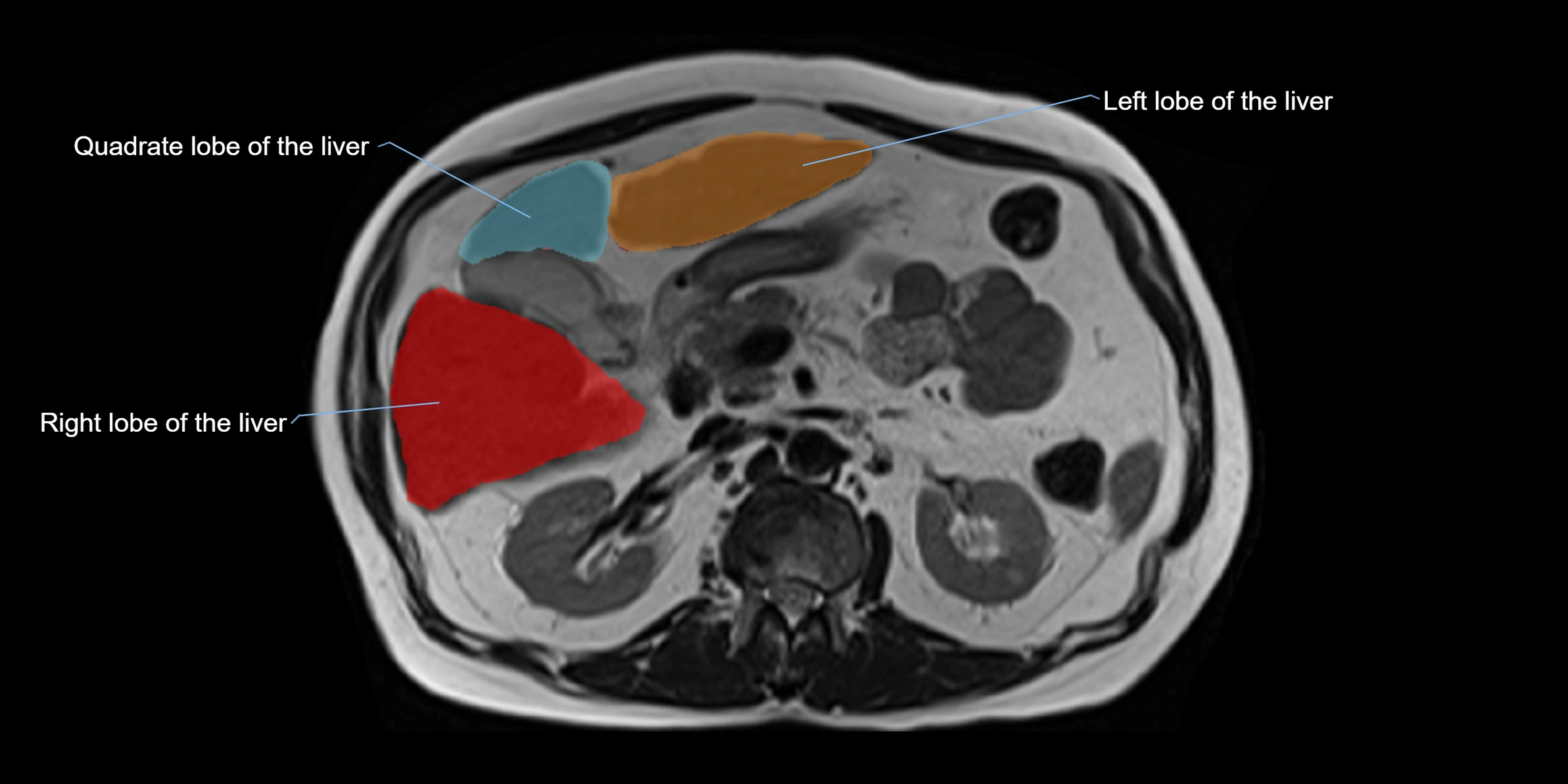 MRI Liver Anatomy – Axial Segments & Lobes (Labeled)
