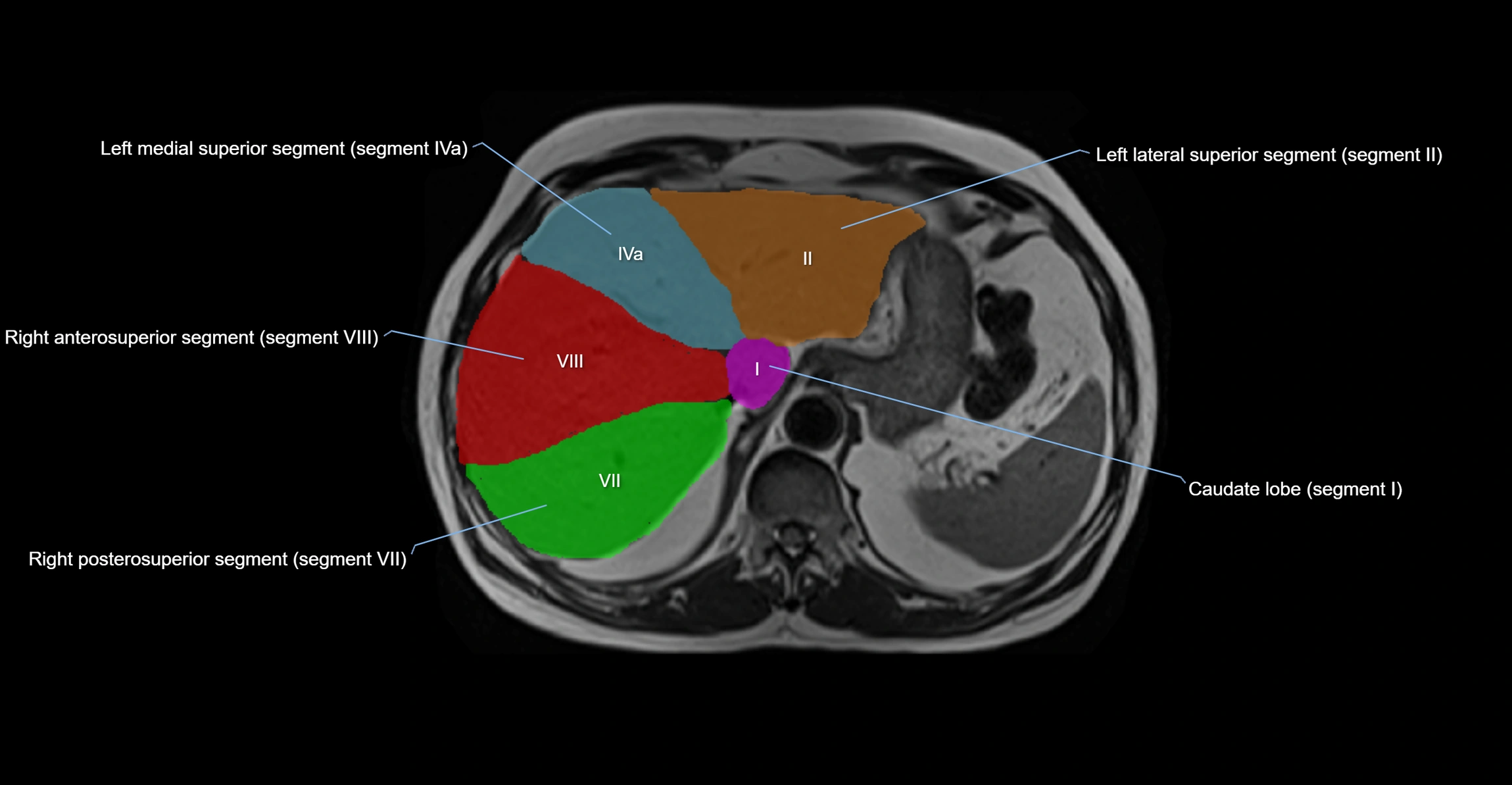 MRI Liver Anatomy – Axial Segments & Lobes (Labeled)