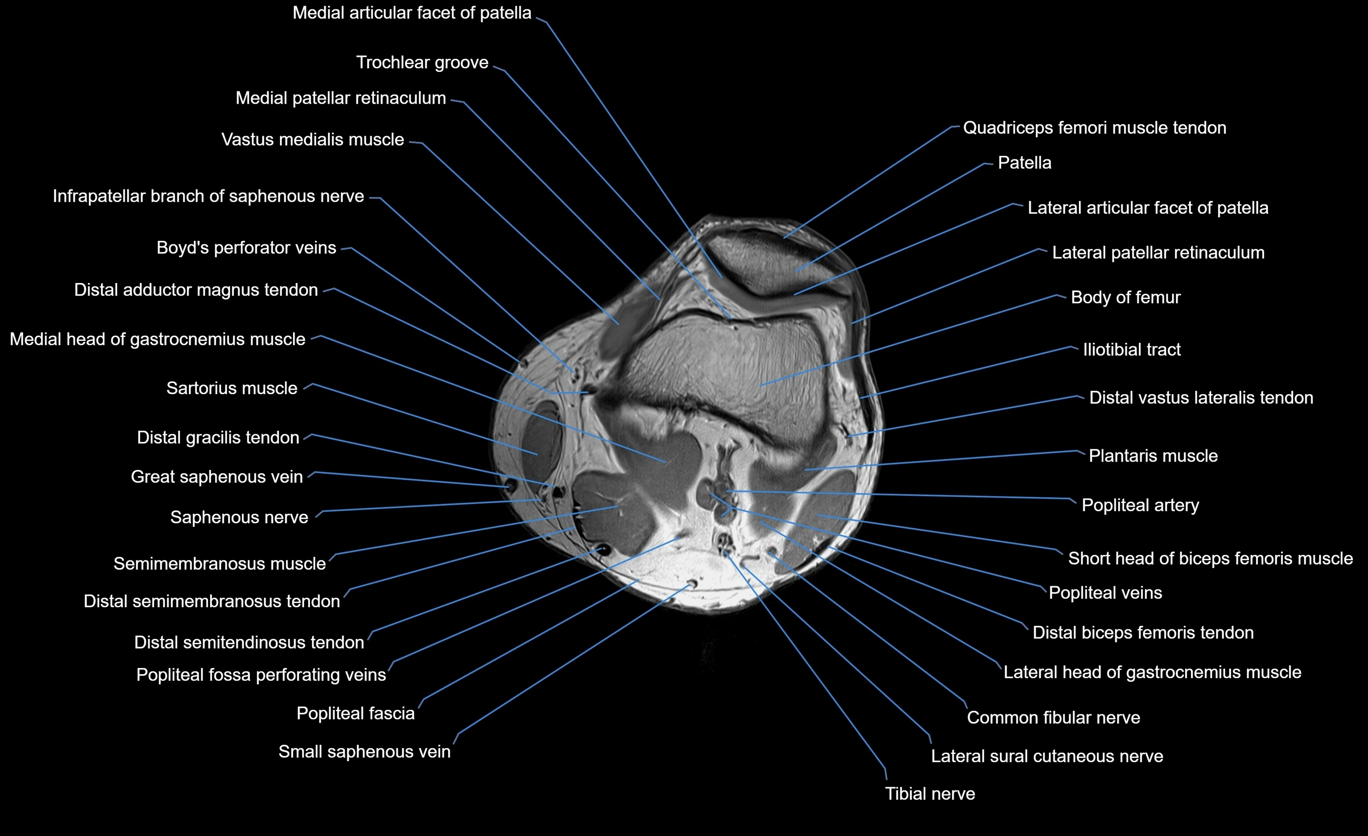 MRI Lower Leg Anatomy – Normal MRI, Labeled Axial, Coronal & Sagittal ...