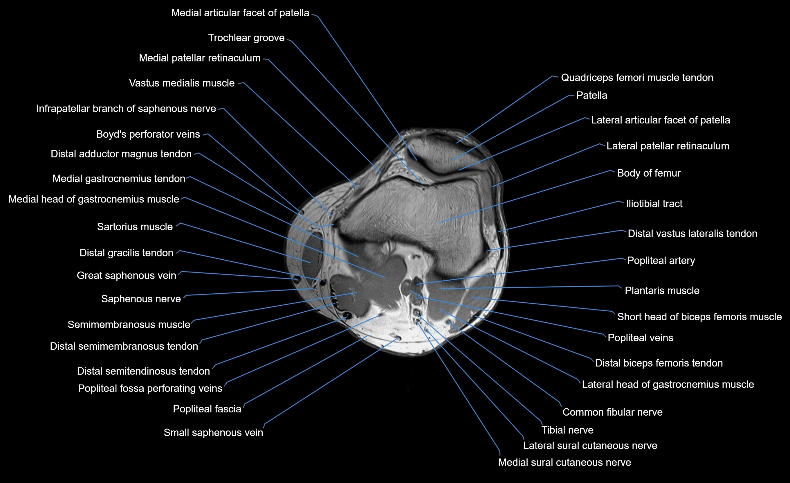 MRI Lower Leg Anatomy – Normal MRI, Labeled Axial, Coronal & Sagittal ...